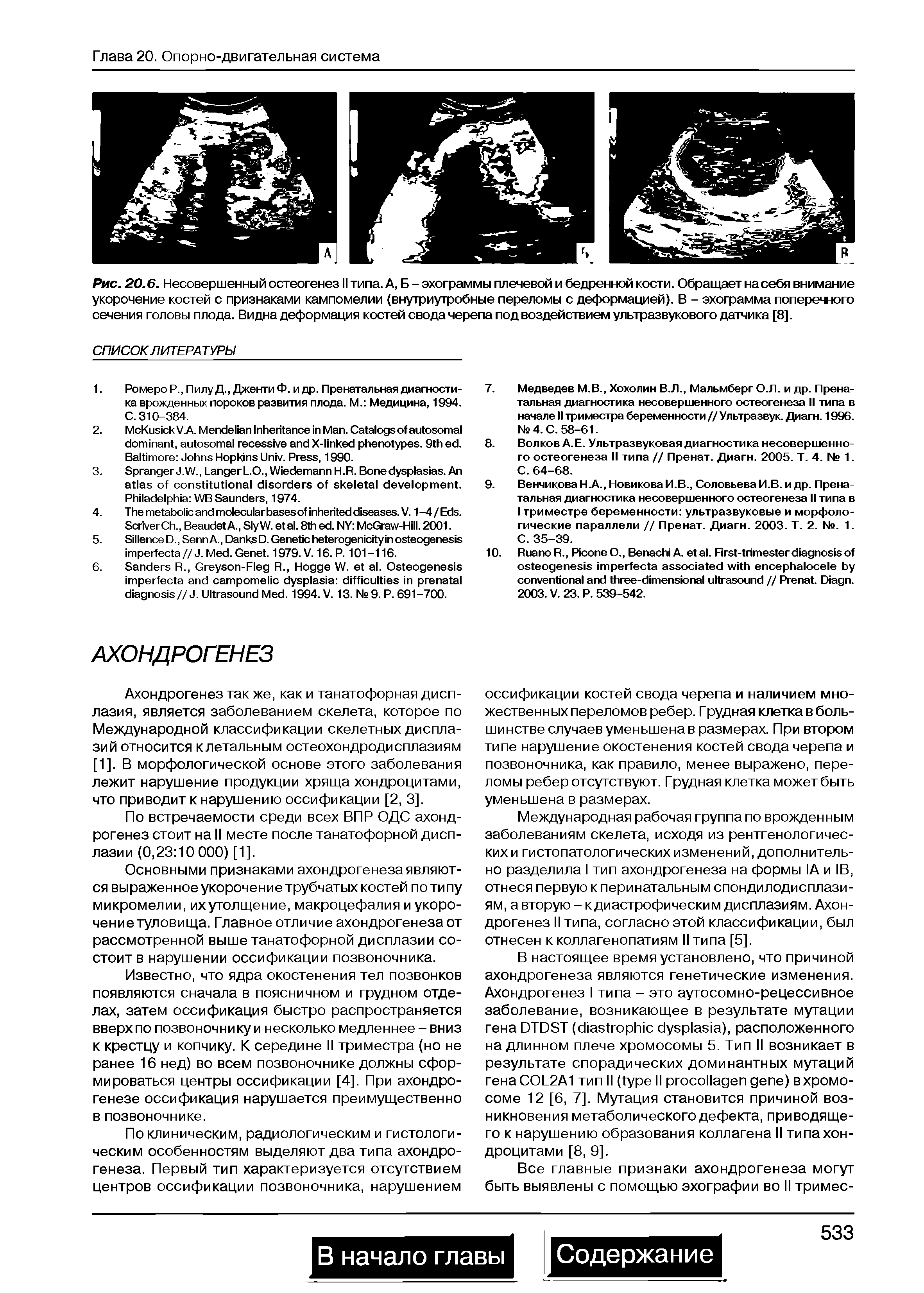 Рис. 20.6. Несовершенный остеогенез II типа. А, Б - эхограммы плечевой и бедренной кости. Обращает на себя внимание укорочение костей с признаками кампомелии (внутриутробные переломы с деформацией). В - эхограмма поперечного сечения головы плода. Видна деформация костей свода черепа под воздействием ультразвукового датчика [8].