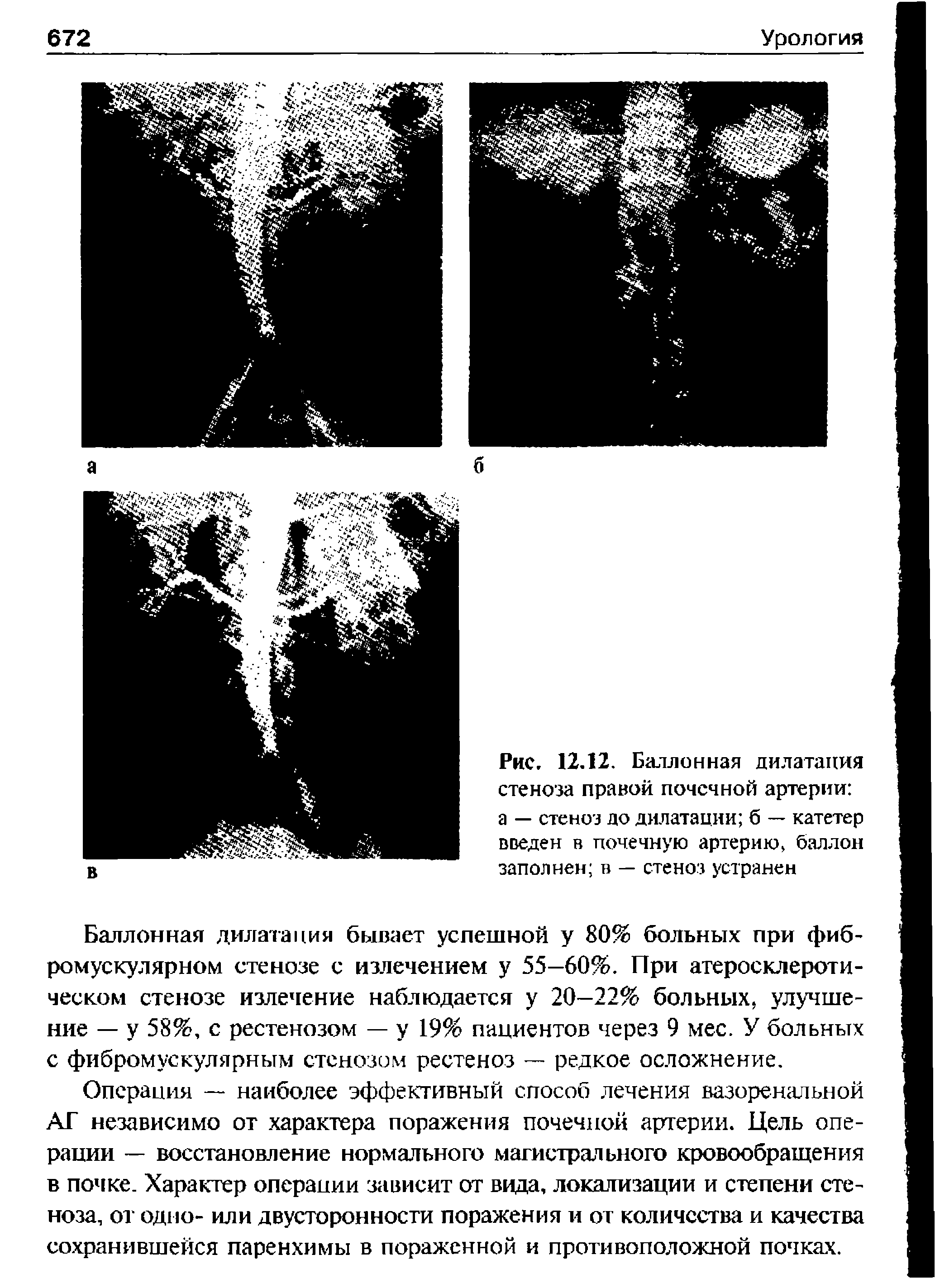 Рис. 12.12. Баллонная дилатация стеноза правой почечной артерии а — стеноз до дилатации б — катетер введен в почечную артерию баллон заполнен в — стеноз устранен...