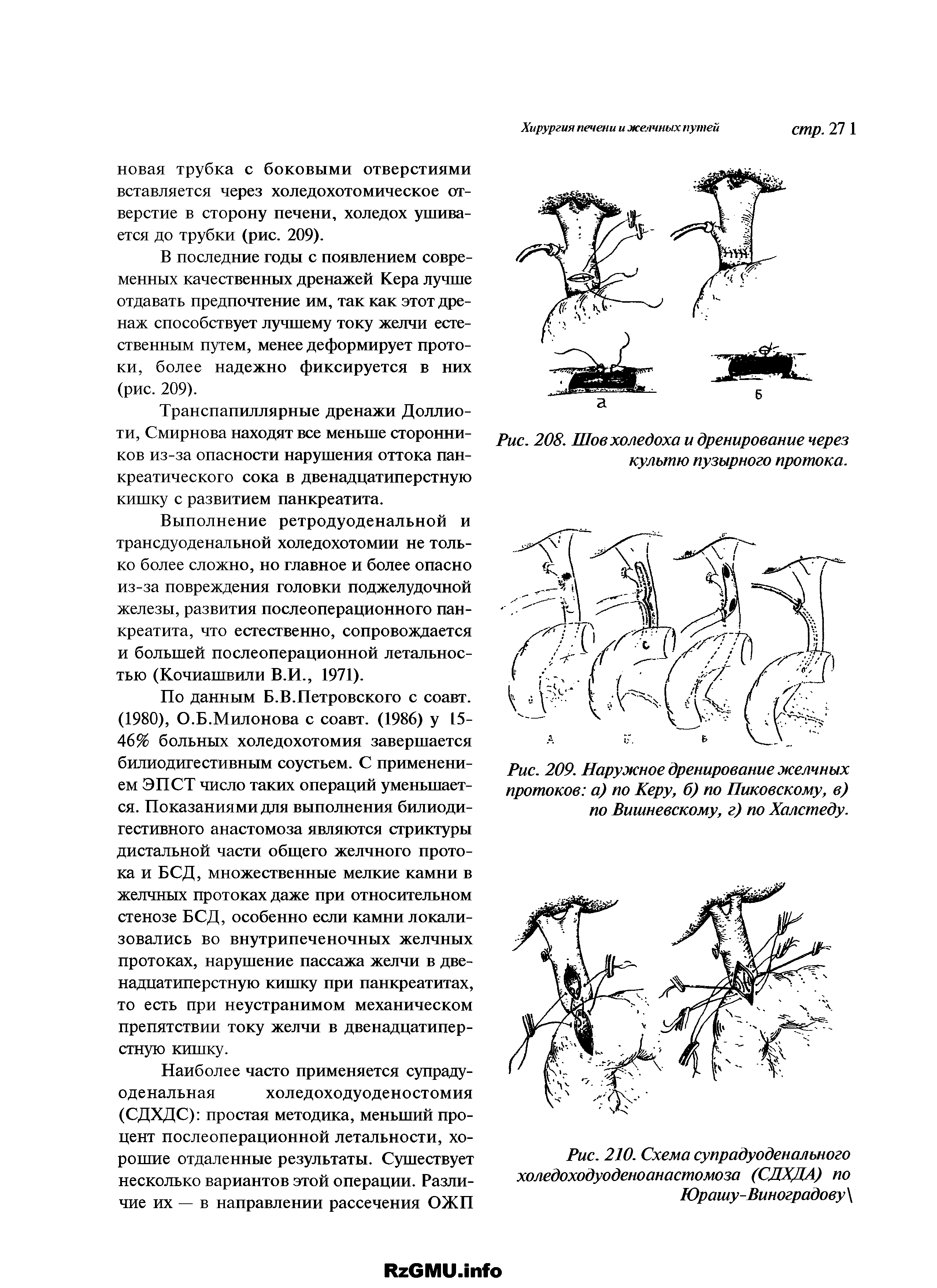 Рис. 208. Шов холедоха и дренирование через культю пузырного протока.