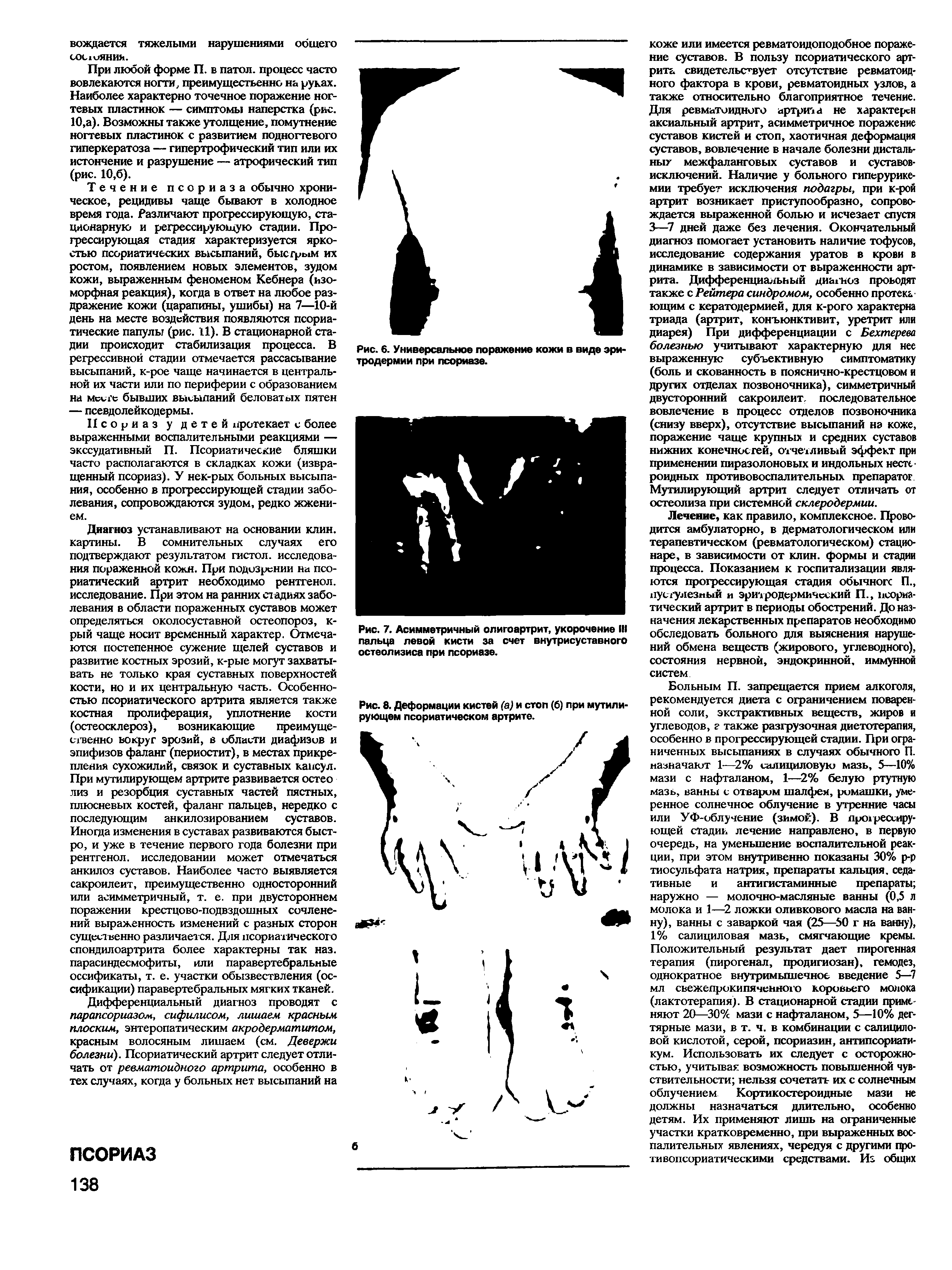 Рис. 8. Деформации кистей (а) и стоп (б) при мутилирующем псориатическом артрите.