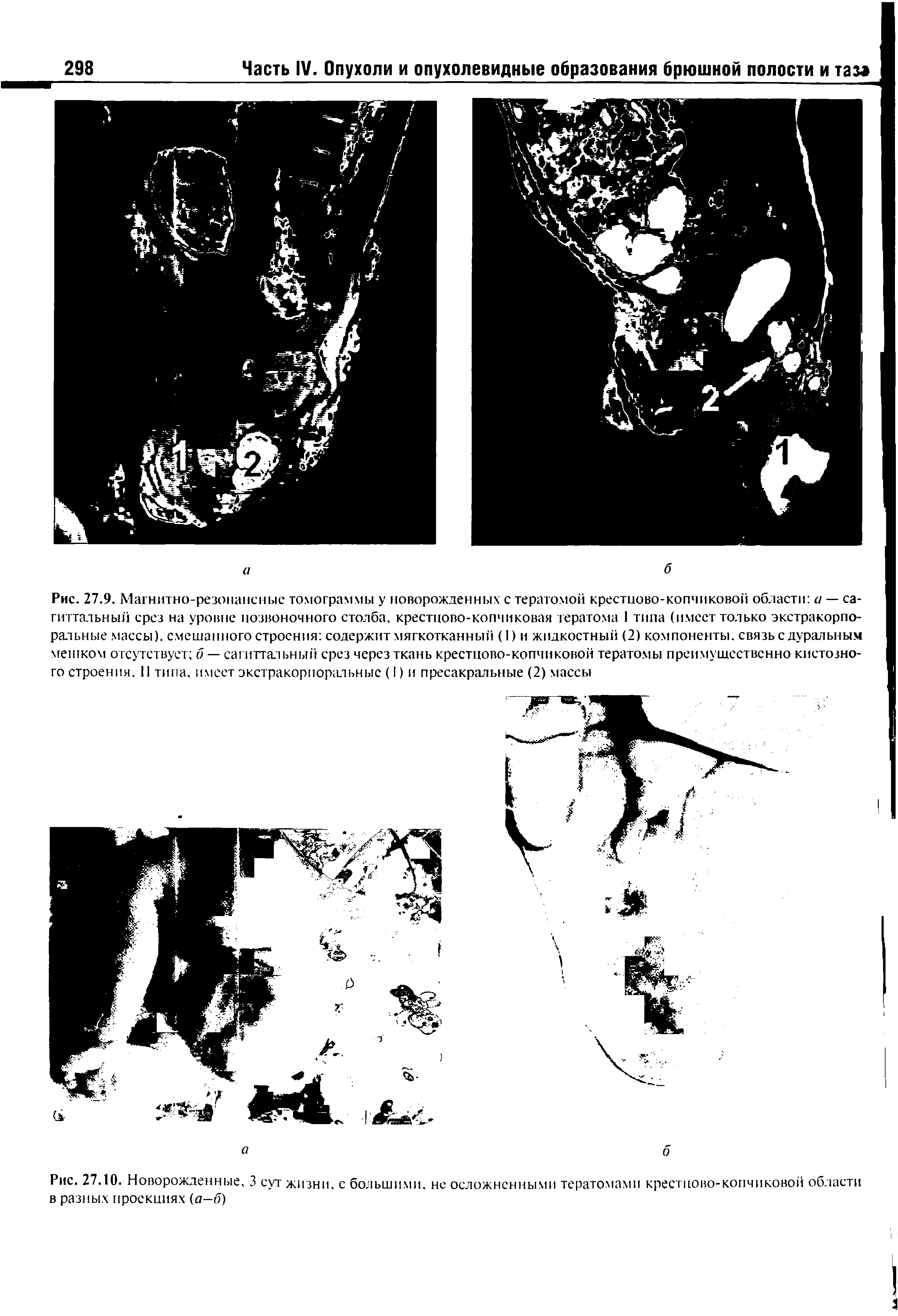 Рис. 27.10. Новорожденные, 3 сут жизни, с большими, не осложненными тератомами крестцово-копчиковой области в разных проекциях (а—б)...