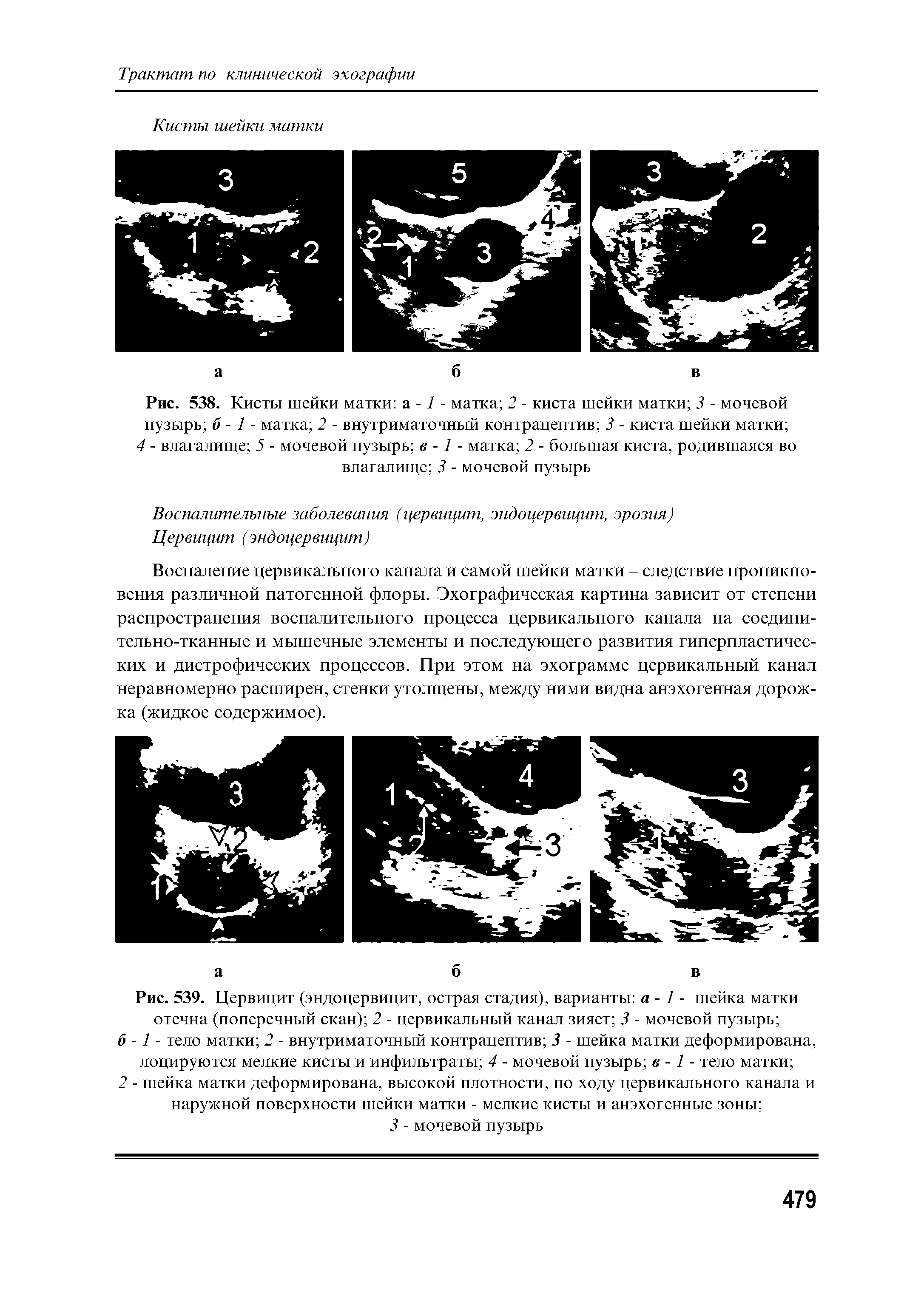 Рис. 539. Цервицит (эндоцервицит, острая стадия), варианты а - 1 - шейка матки отечна (поперечный скан) 2 - цервикальный канал зияет 3 - мочевой пузырь ...