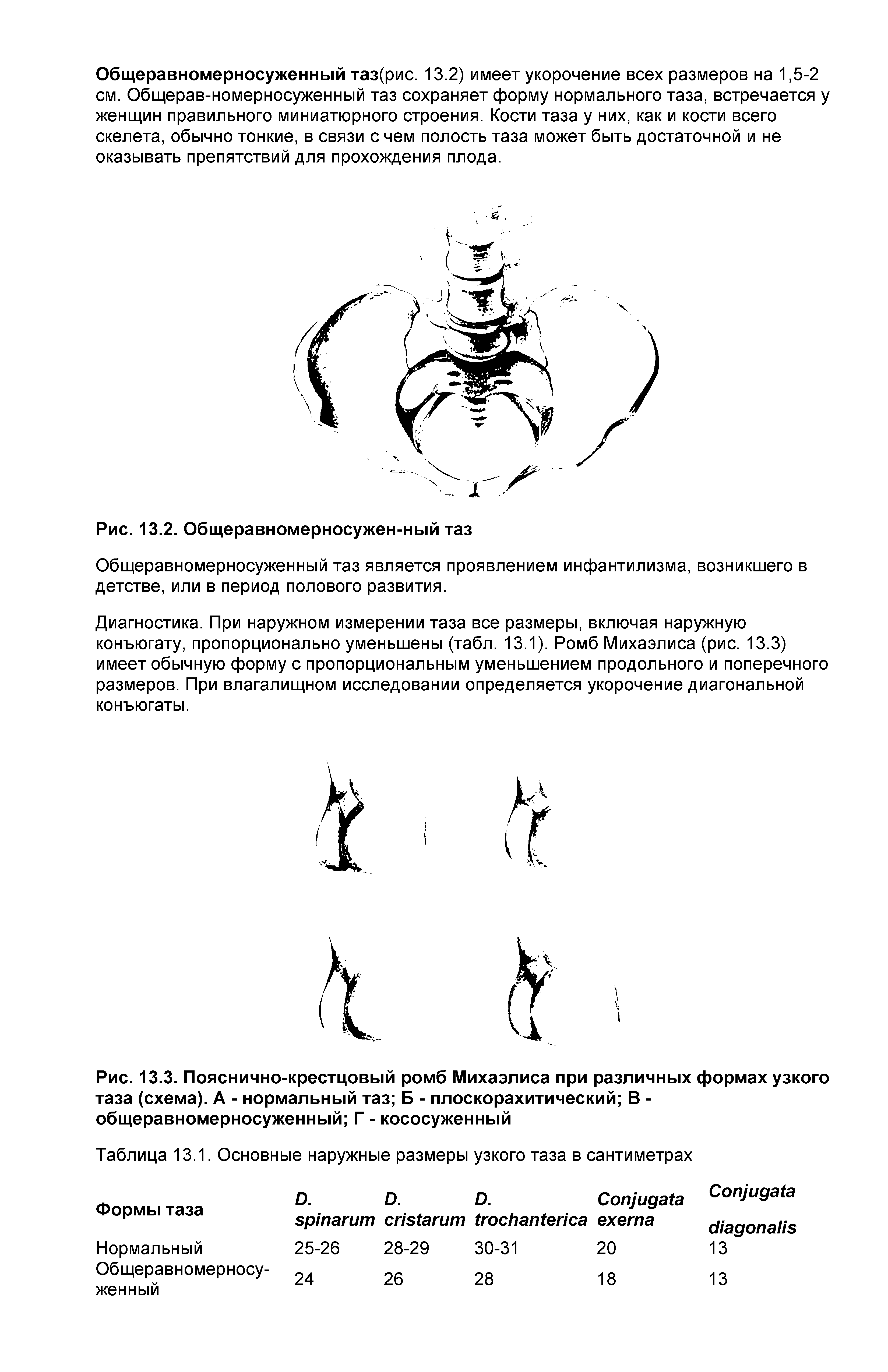 Рис. 13.3. Пояснично-крестцовый ромб Михаэлиса при различных формах узкого таза (схема). А - нормальный таз Б - плоскорахитический В -общеравномерносуженный Г - кососуженный...