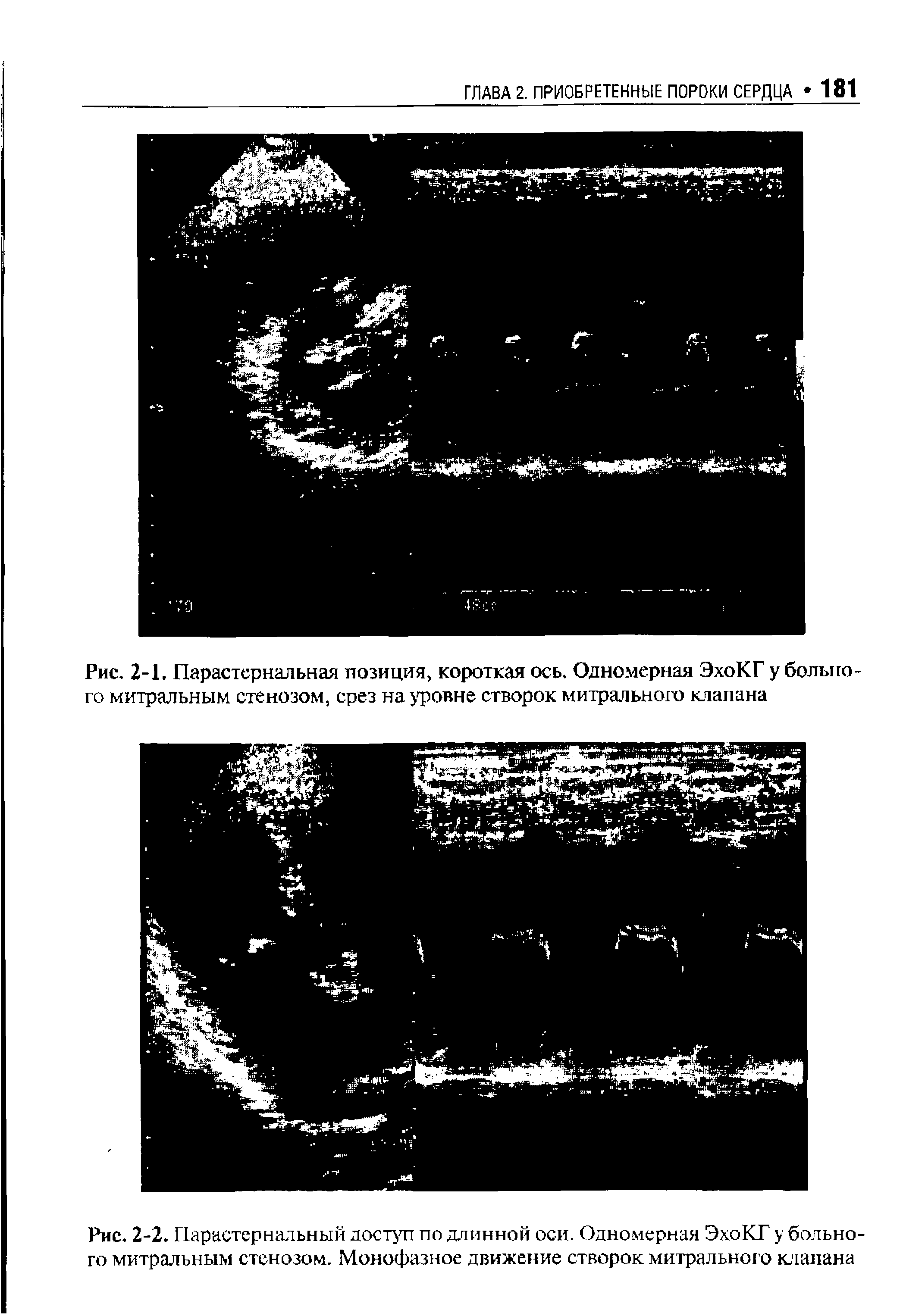 Рис. 2-2. Парастернальный доступ по длинной оси. Одномерная ЭхоКГ у больного митральным стенозом. Монофазное движение створок митрального клапана...