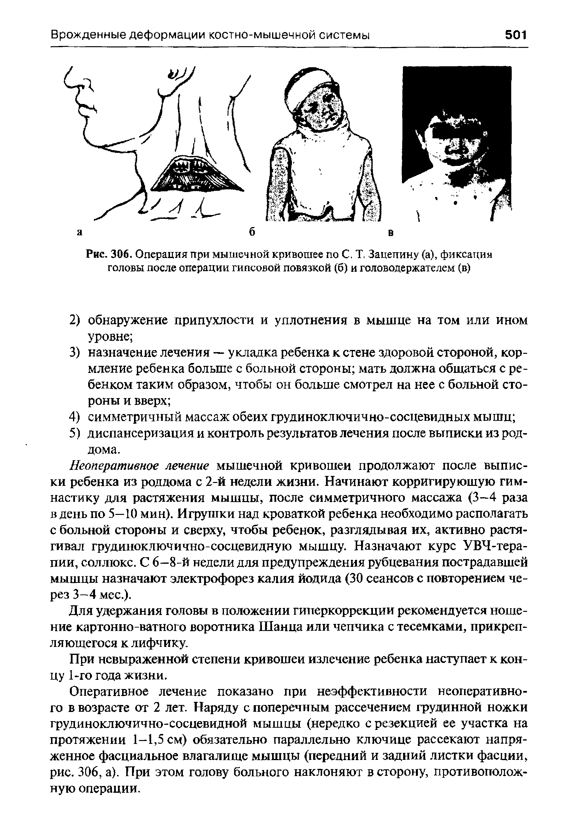 Рис. 306. Операция при мышечной кривошее по С. Т, Зацепину (а), фиксация головы после операции гипсовой повязкой (б) и головодержателем (в)...