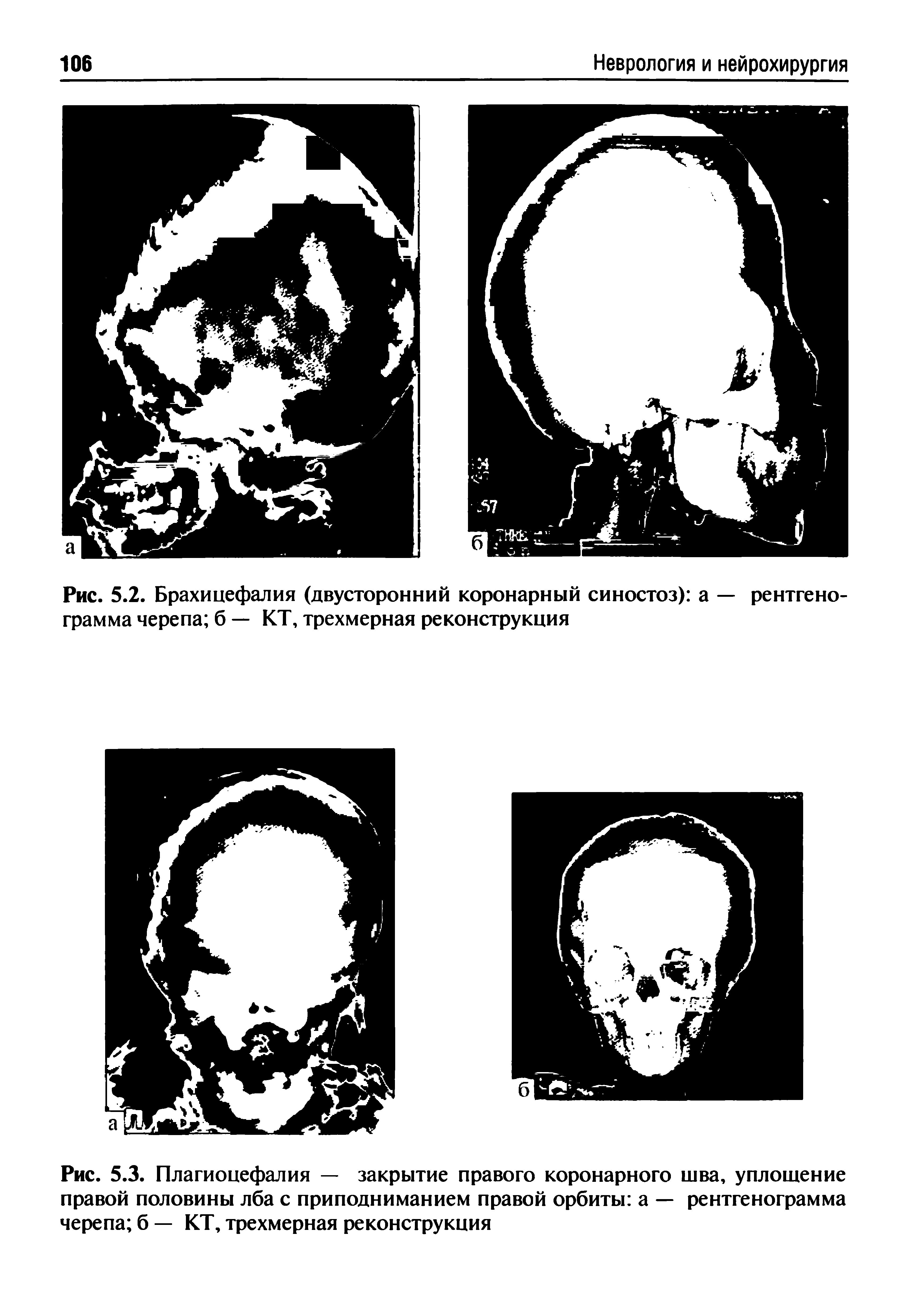 Рис. 5.3. Плагиоцефалия — закрытие правого коронарного шва, уплощение правой половины лба с приподниманием правой орбиты а — рентгенограмма черепа б — КТ, трехмерная реконструкция...