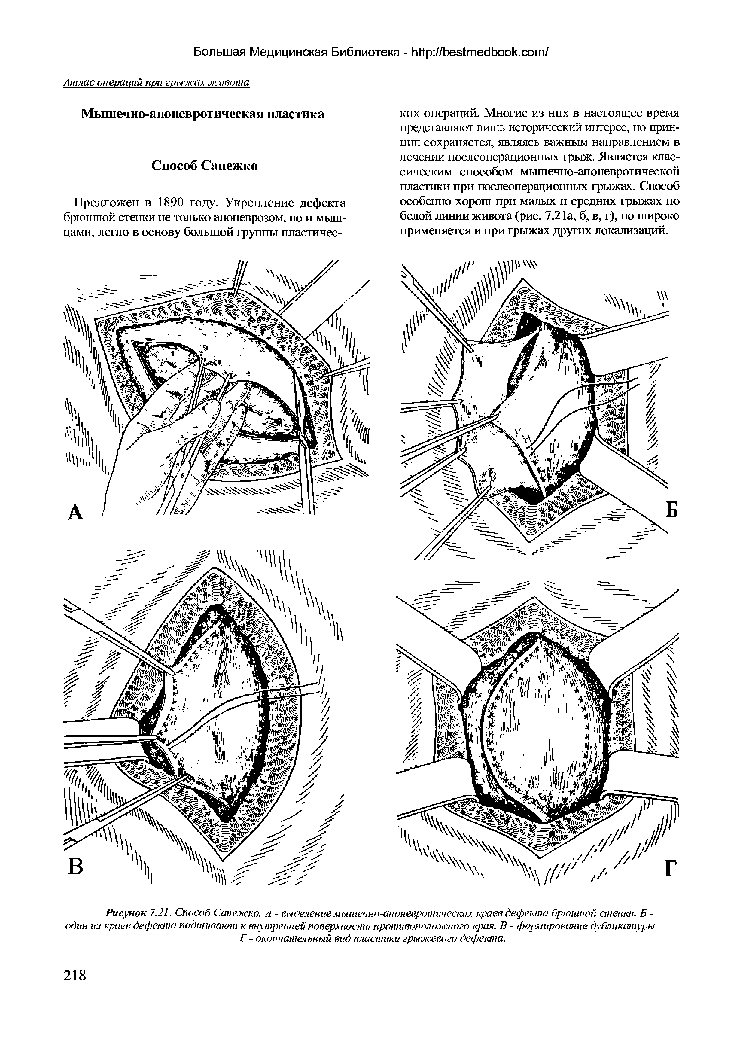 Рисунок 7.21. Способ Сапежко. А - выселение мышечно-апоневротических краев дефекта брюшной стенки. Б -один из краев дефекта подшивают к внутренней поверхности противоположного края. В - формирование дубликатуры Г - окончательный вид пластики грыжевого дефекта.