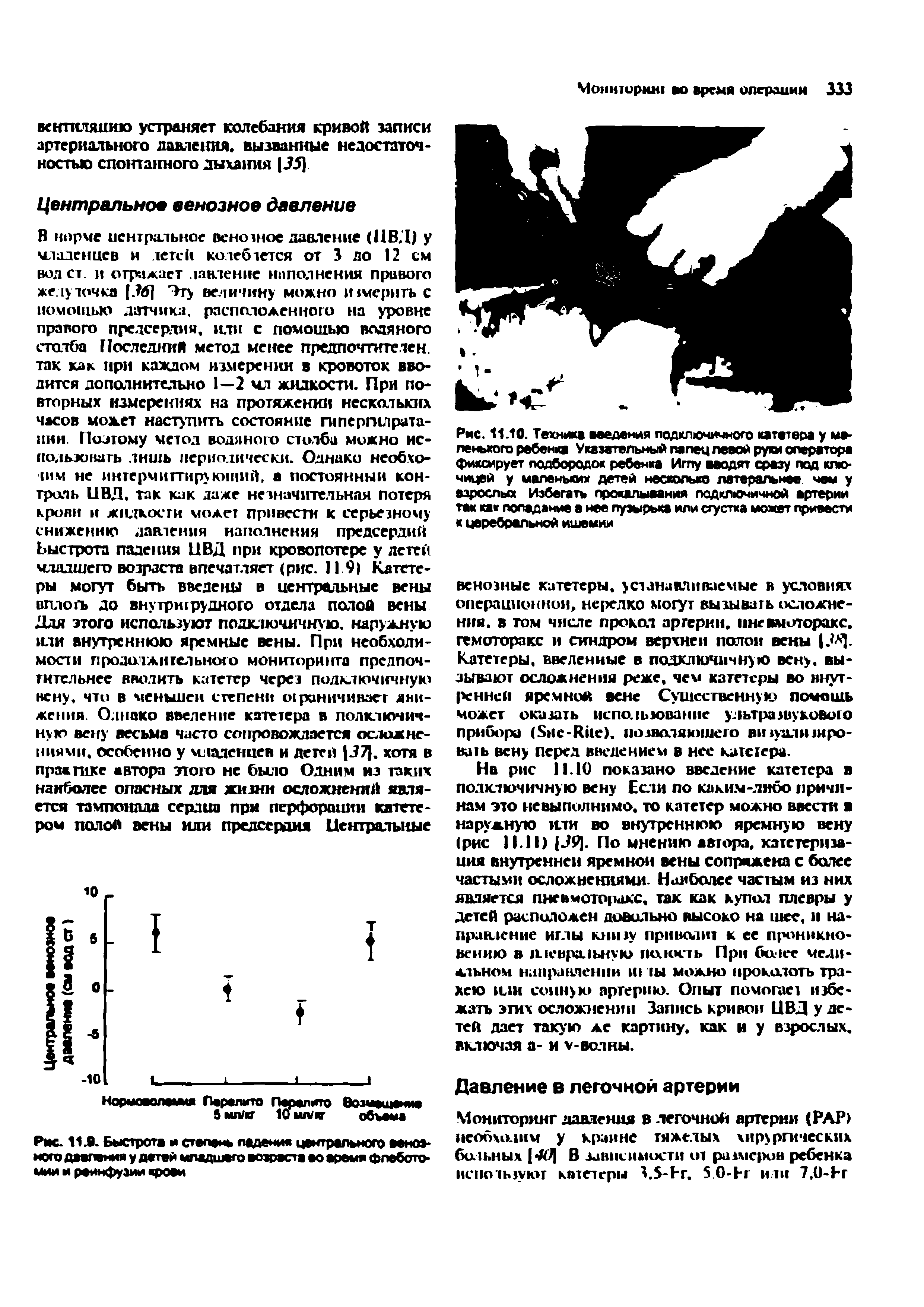 Рис. 11.10. Техника введения подключичного катетера у меленького ребенка Указательный палец левой руки операторе фиксирует подбородок ребенка Иглу вводят сразу под ключицей у маленьких детей несколько латеральное чем у взрослых Избегать прокалывания подключичной артерии так как попадание а нее пузырька или сгустка может привести к церебральной ишемии...