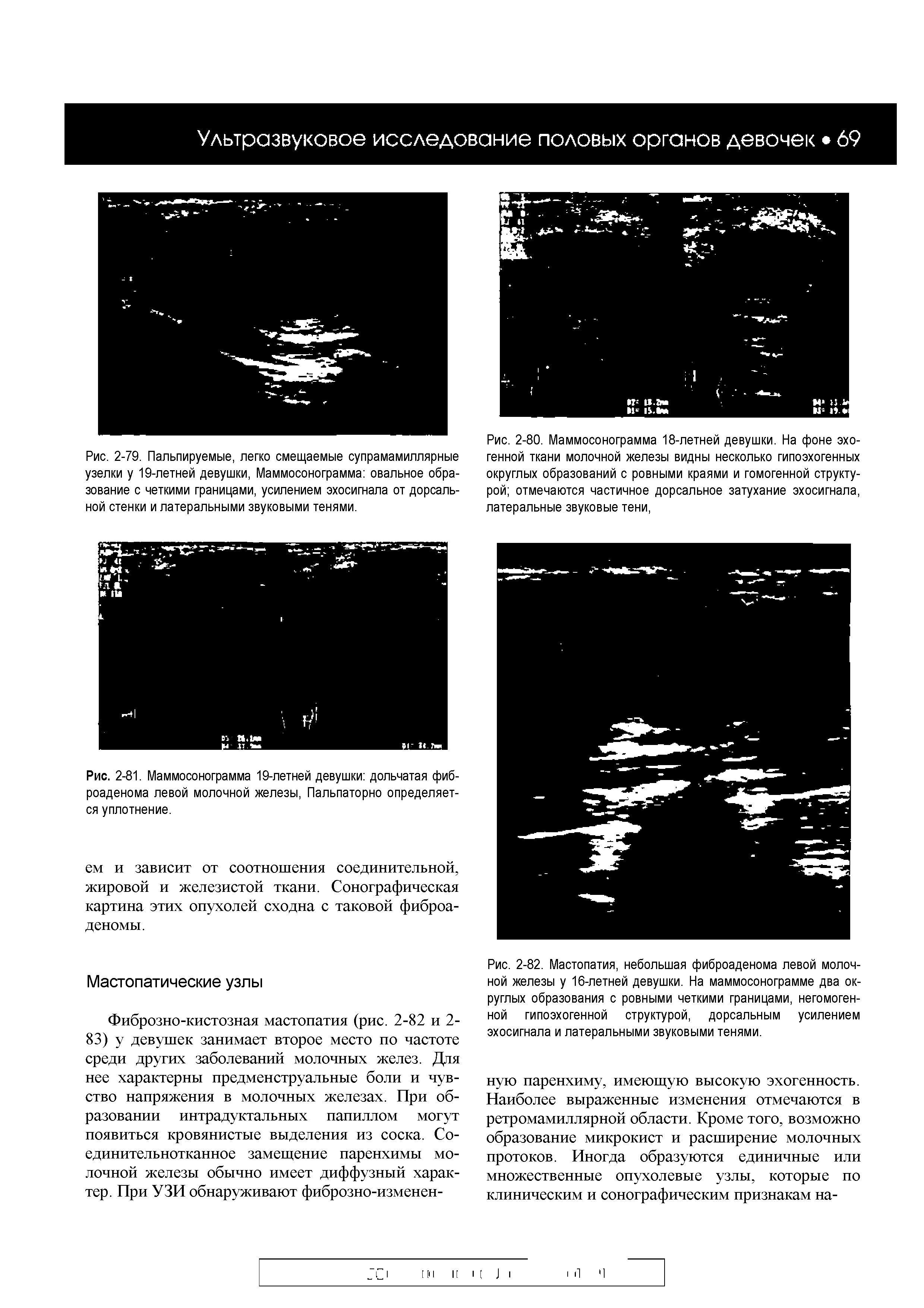 Рис. 2-82. Мастопатия, небольшая фиброаденома левой молочной железы у 16-летней девушки. На маммосонограмме два округлых образования с ровными четкими границами, негомогенной гипоэхогенной структурой, дорсальным усилением эхосигнала и латеральными звуковыми тенями.