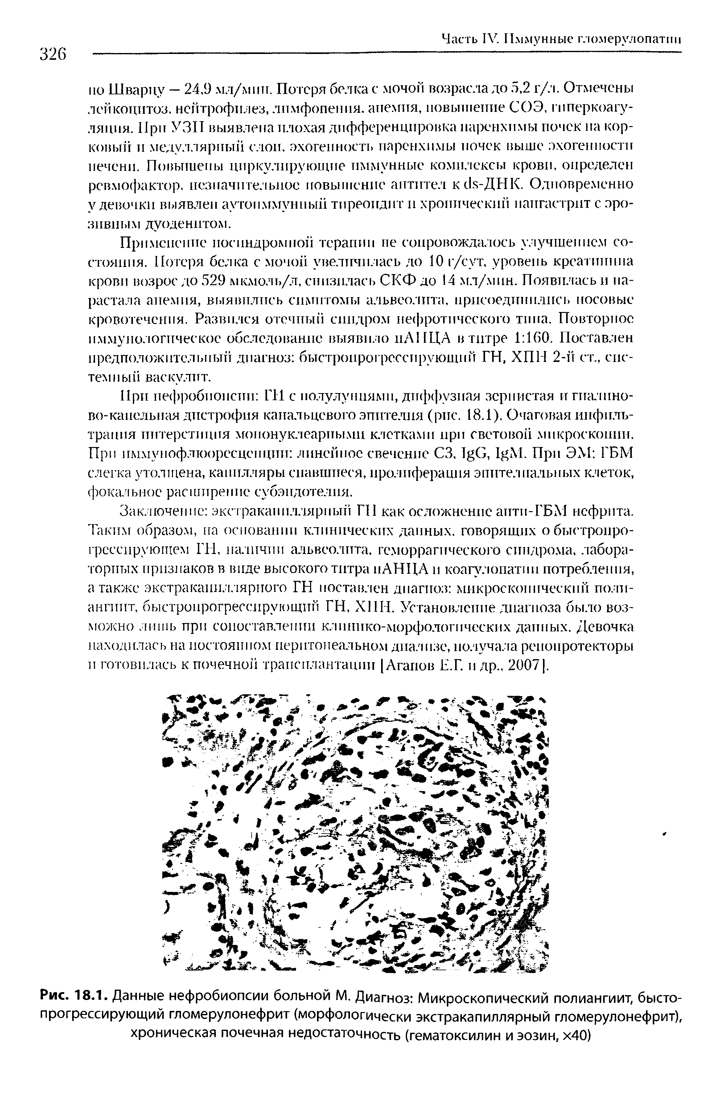 Рис. 18.1. Данные нефробиопсии больной М. Диагноз Микроскопический полиангиит, бысто-прогрессирующий гломерулонефрит (морфологически экстракапиллярный гломерулонефрит), хроническая почечная недостаточность (гематоксилин и эозин, х40)...
