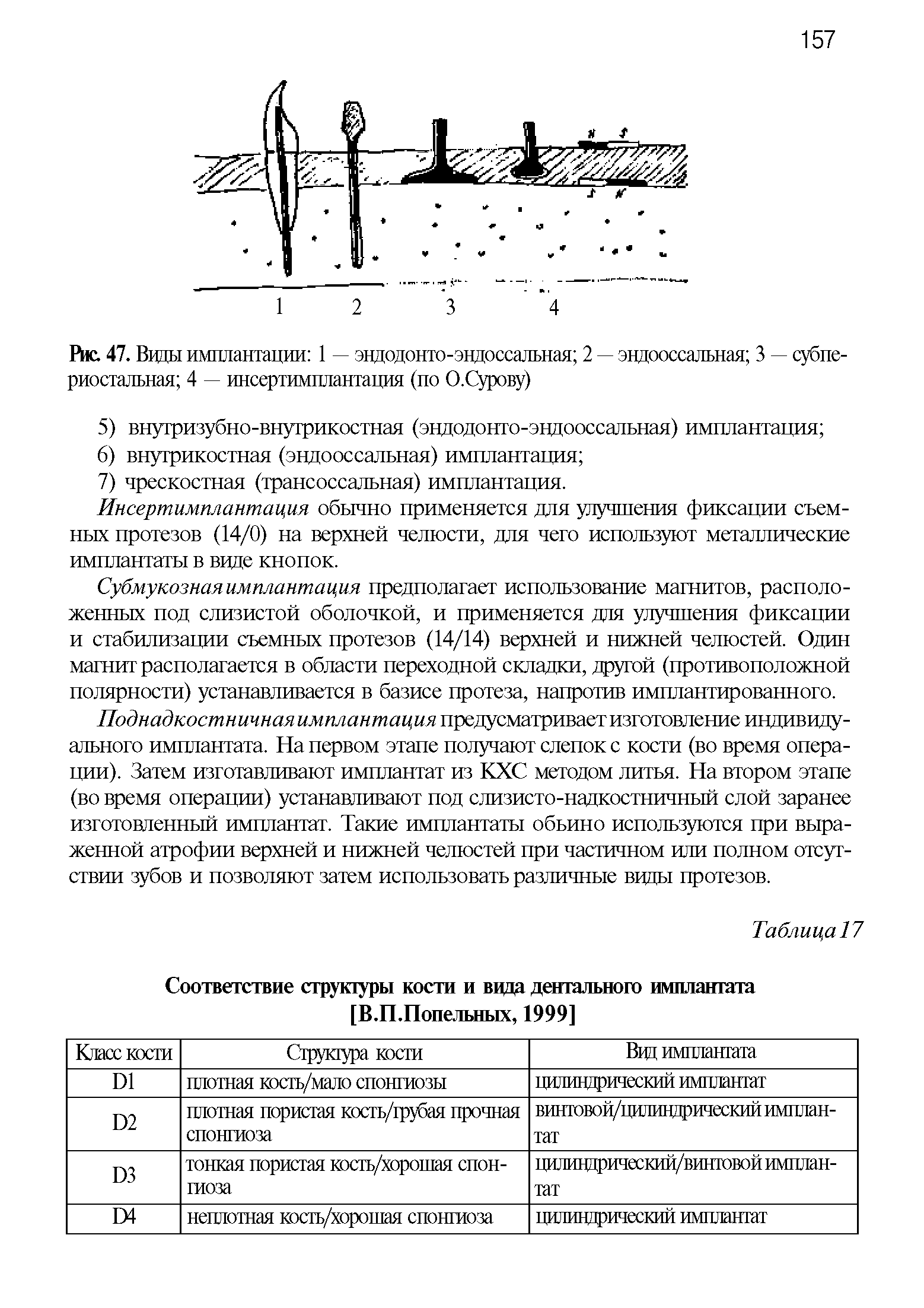 Рис. 47. Ввды имплантации 1 — эндодонто-эндоссальная 2 — эндооссальная 3 — субпериостальная 4 — инсертимплантация (по О.Сурову)...