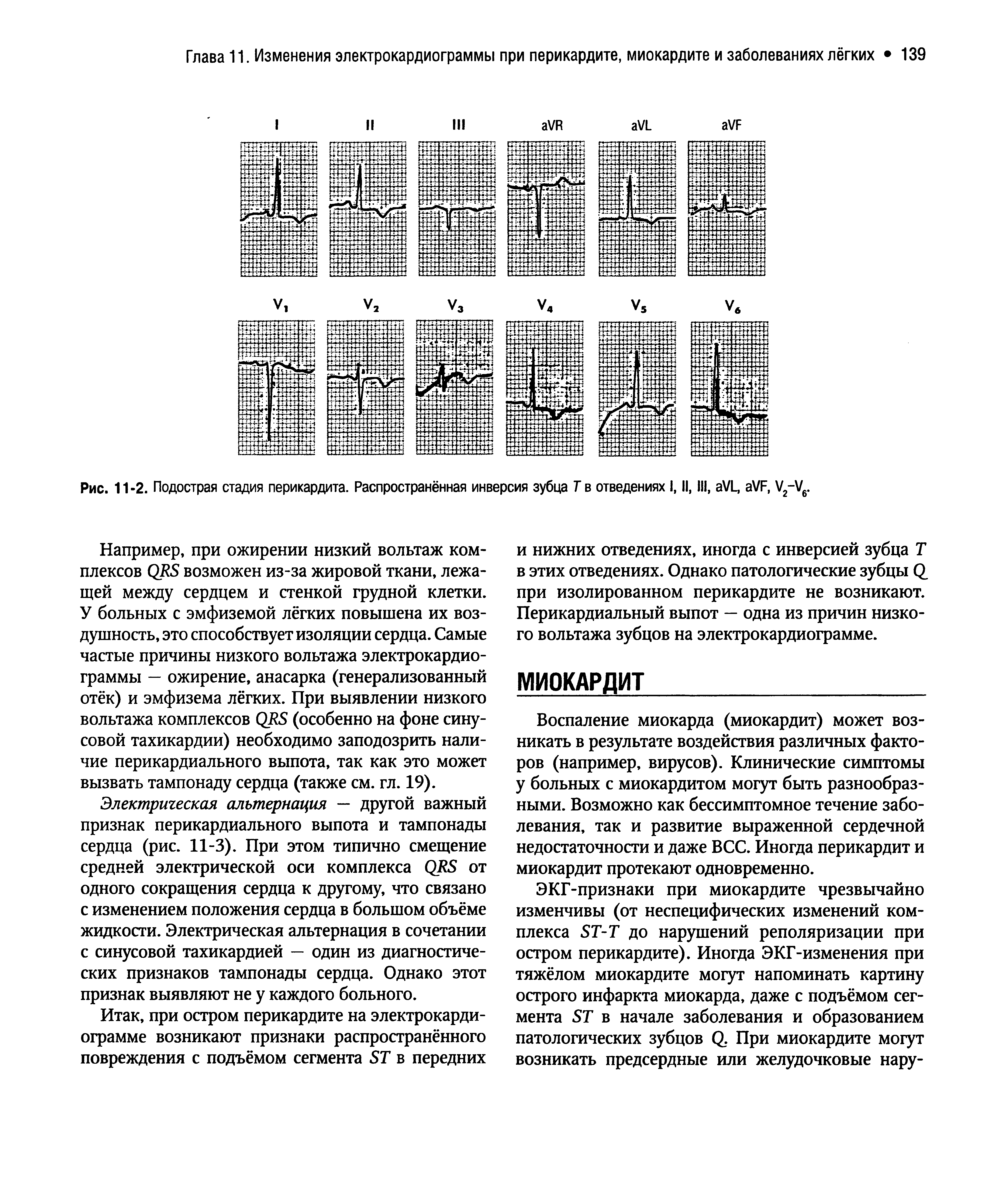 Рис. 11-2. Подострая стадия перикардита. Распространённая инверсия зубца Т в отведениях I, II, III, VL, VF, V2-V6.