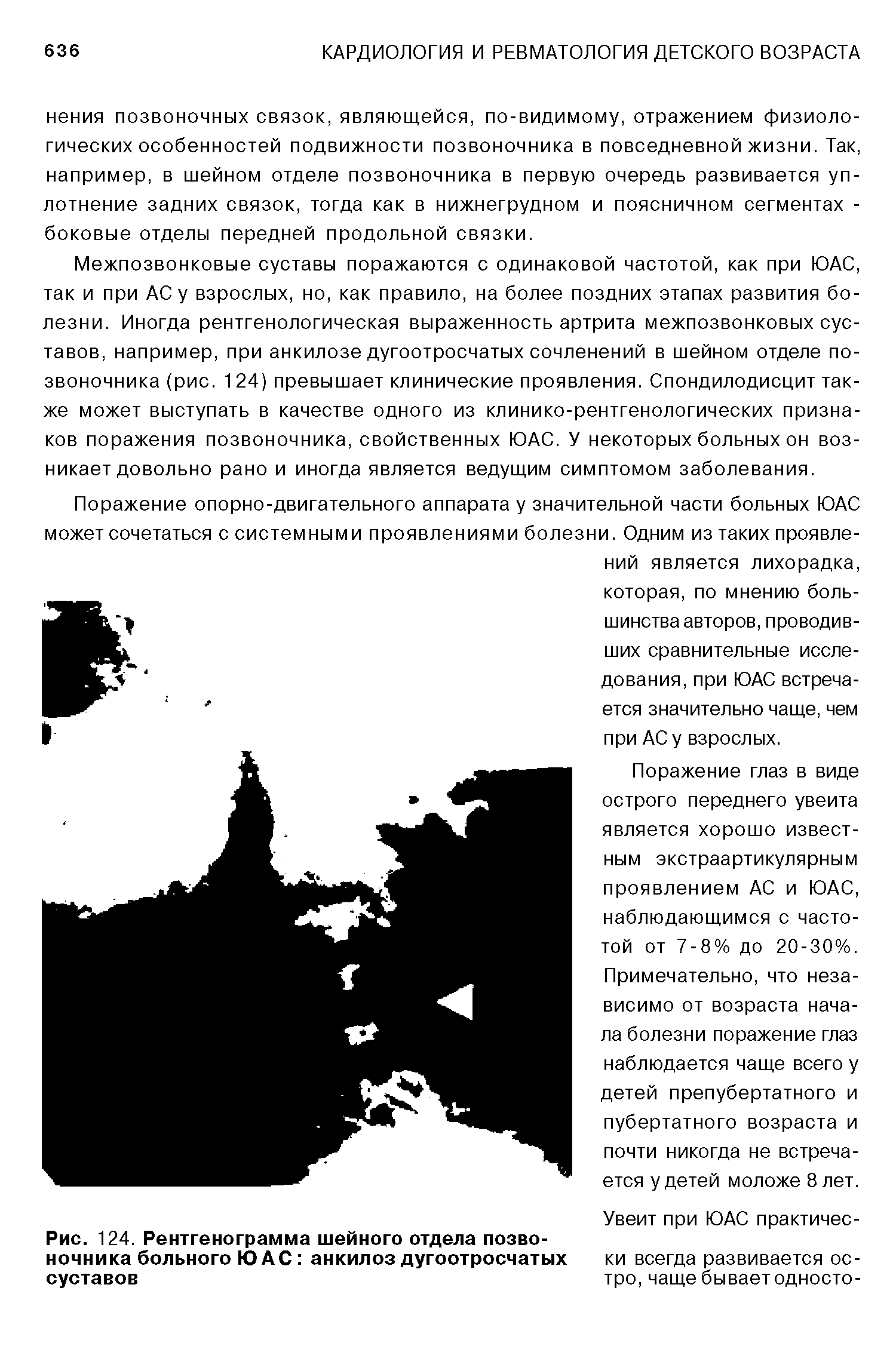 Рис. 124. Рентгенограмма шейного отдела позвоночника больного ЮАС анкилоз дугоотросчатых суставов...