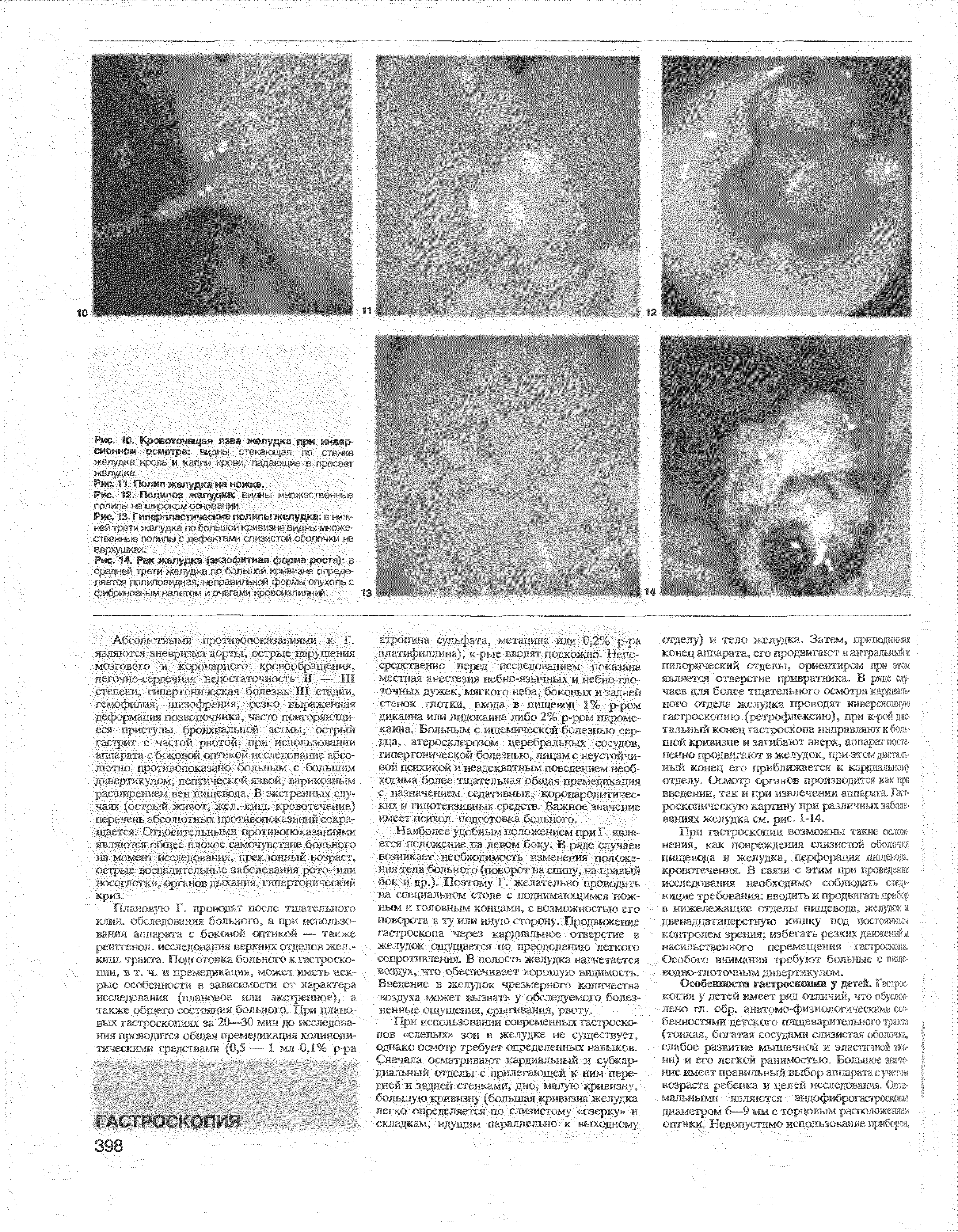 Рис. 14 Рвк желудка якзсф ггна Форма роста) L . >. чл ж- тол и .M , > т < ляется лолййв йЖ-вораЙ йвй) рйййопу)ет с фибри з1Огнщ1етомиб 13...