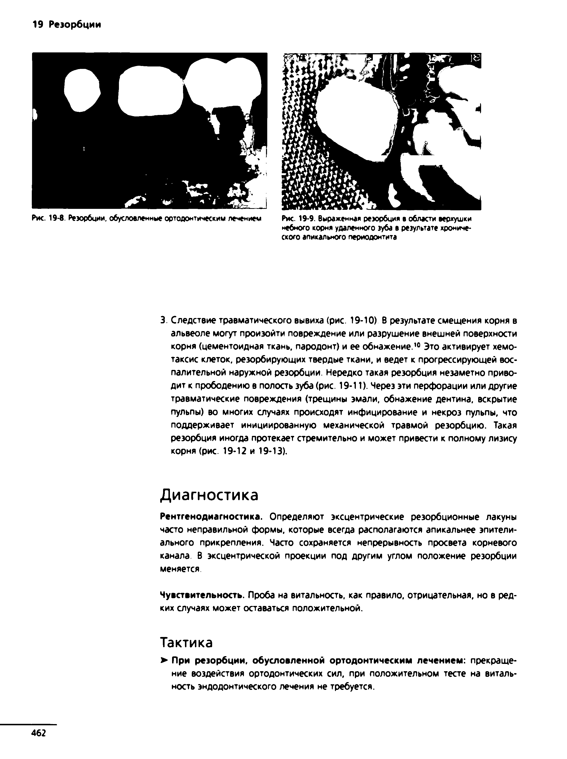 Рис. 19-8. Резорбции. обусловленные ортодонтическим лечением Рис. 19-9. Выраженная резорбция в области верхушки небного корня удаленного зуба в результате хронического апикального периодонтита...