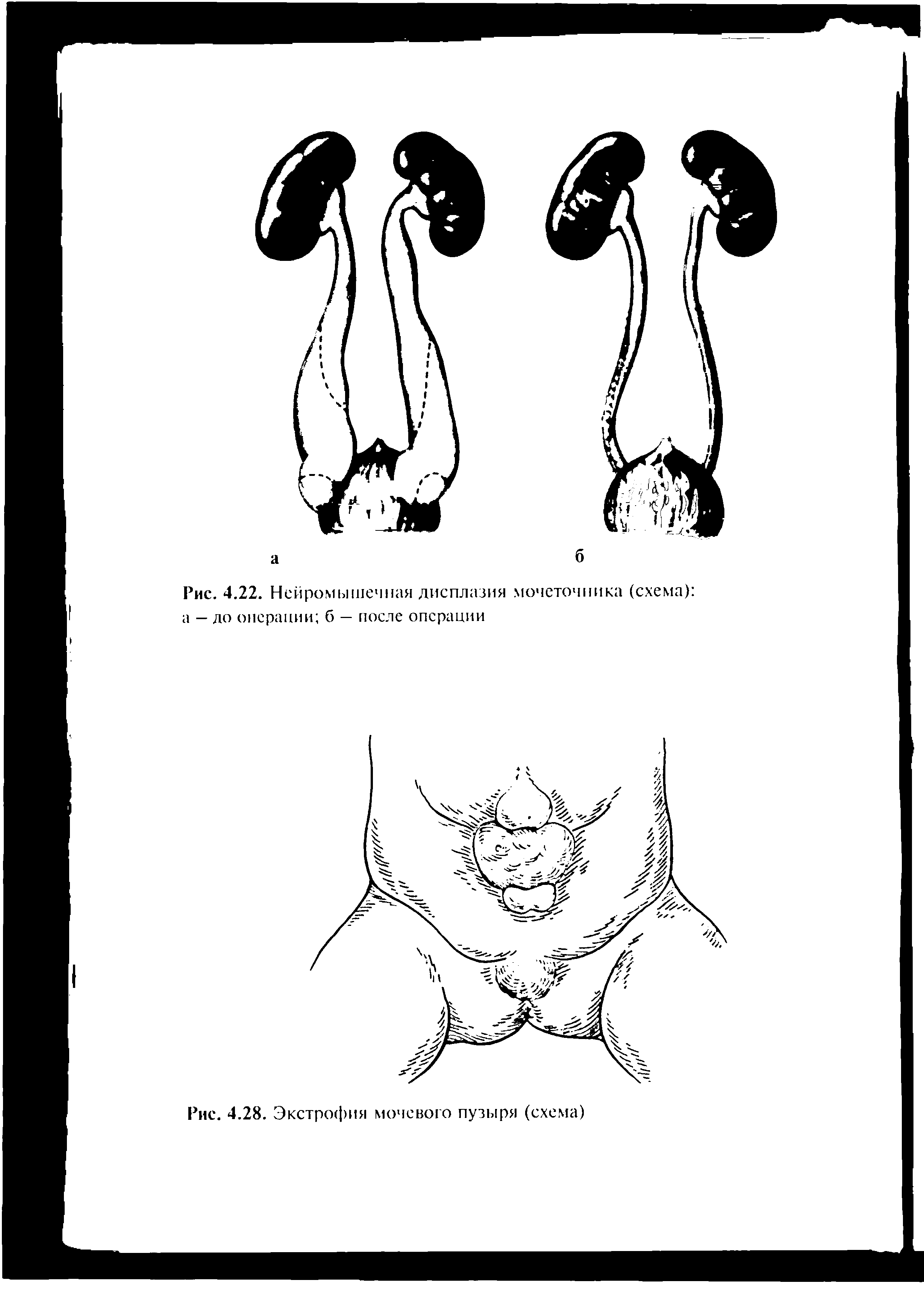 Рис. 4.22. Нейромышечная дисплазия мочеточника (схема) а — до операции б — после операции...
