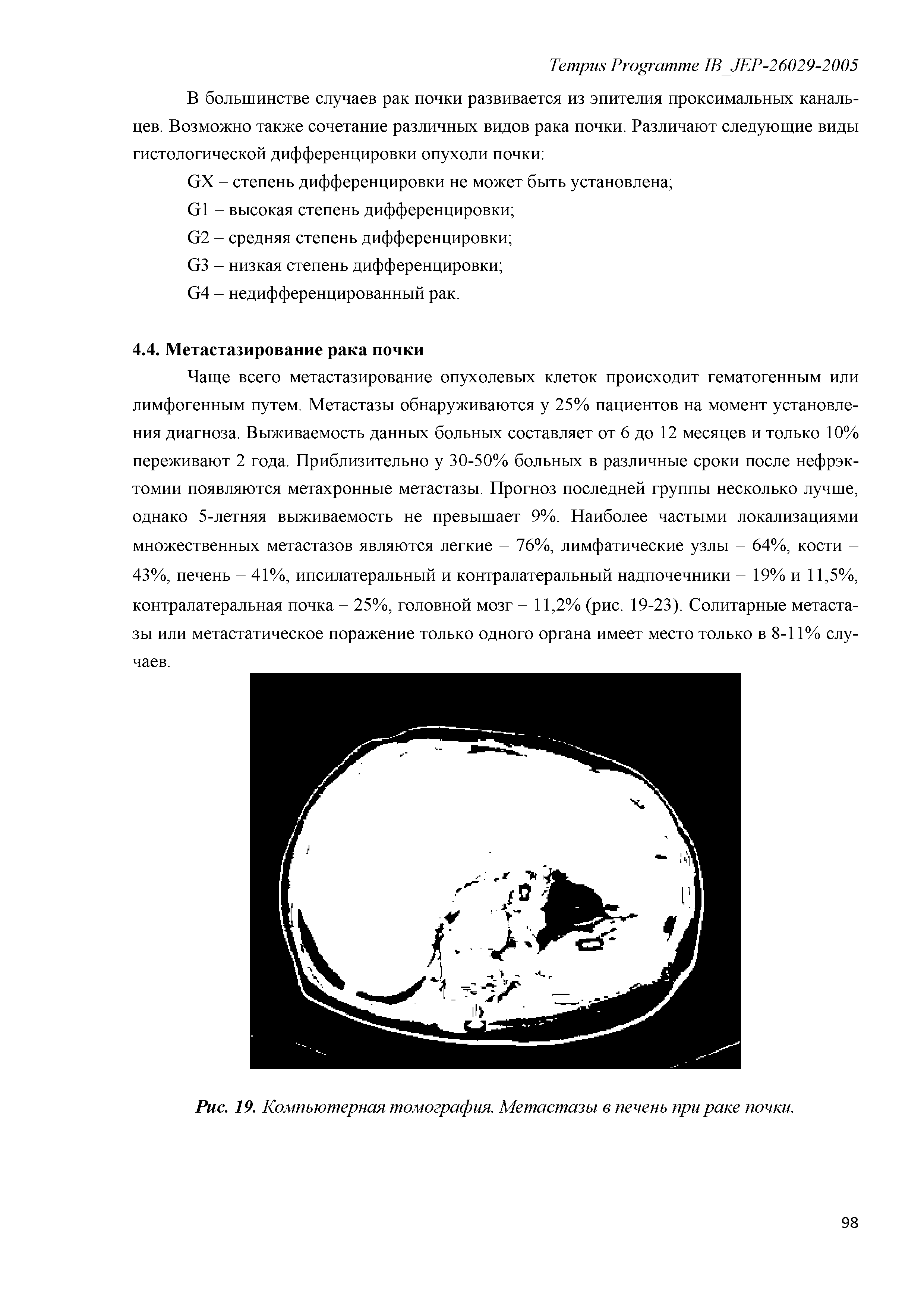 Рис. 19. Компьютерная томография. Метастазы в печень при раке почки.