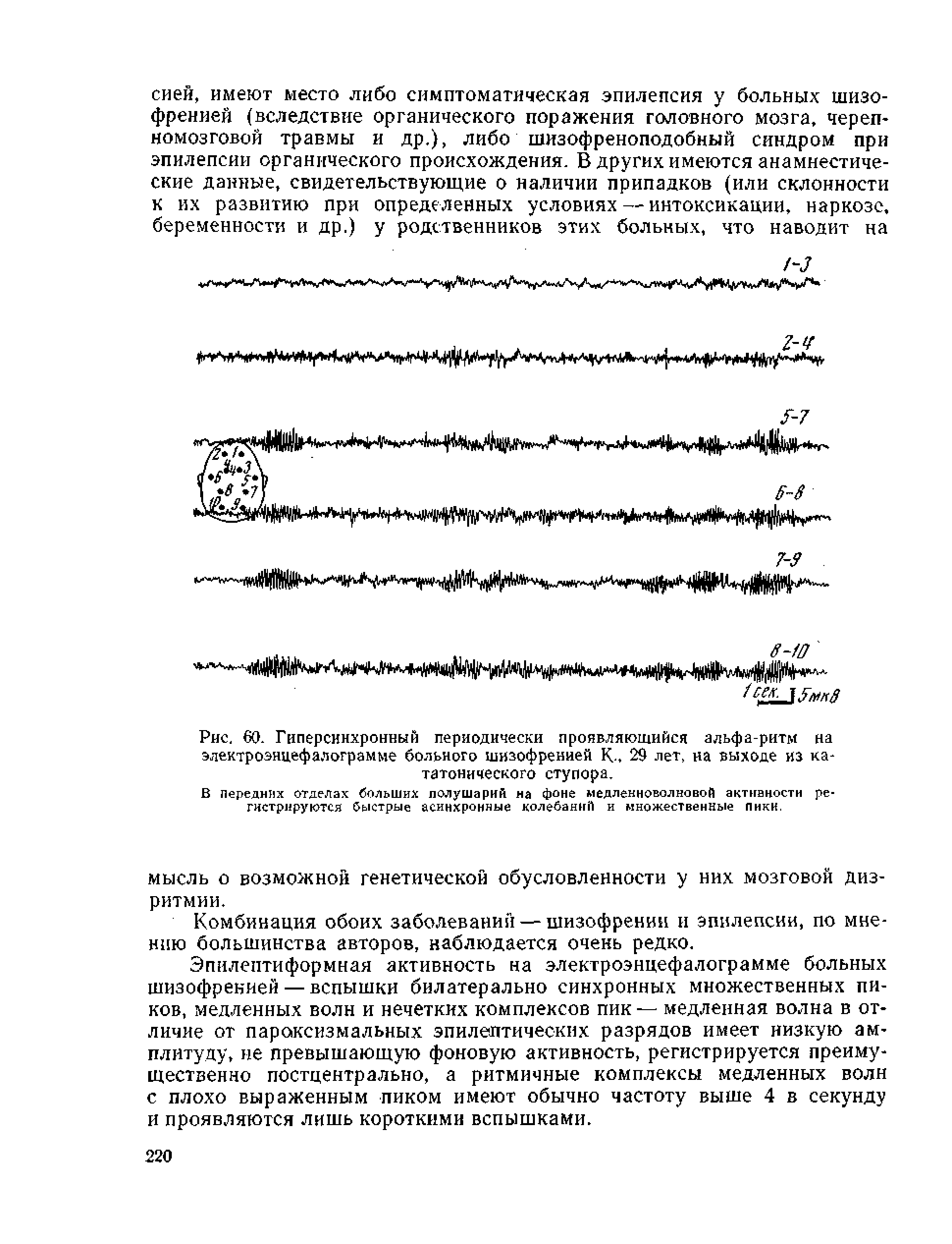 Рис. 60. Гиперсинхронный периодически проявляющийся альфа-ритм на электроэнцефалограмме больного шизофренией К., 25 лет, на выходе из кататонического ступора,...