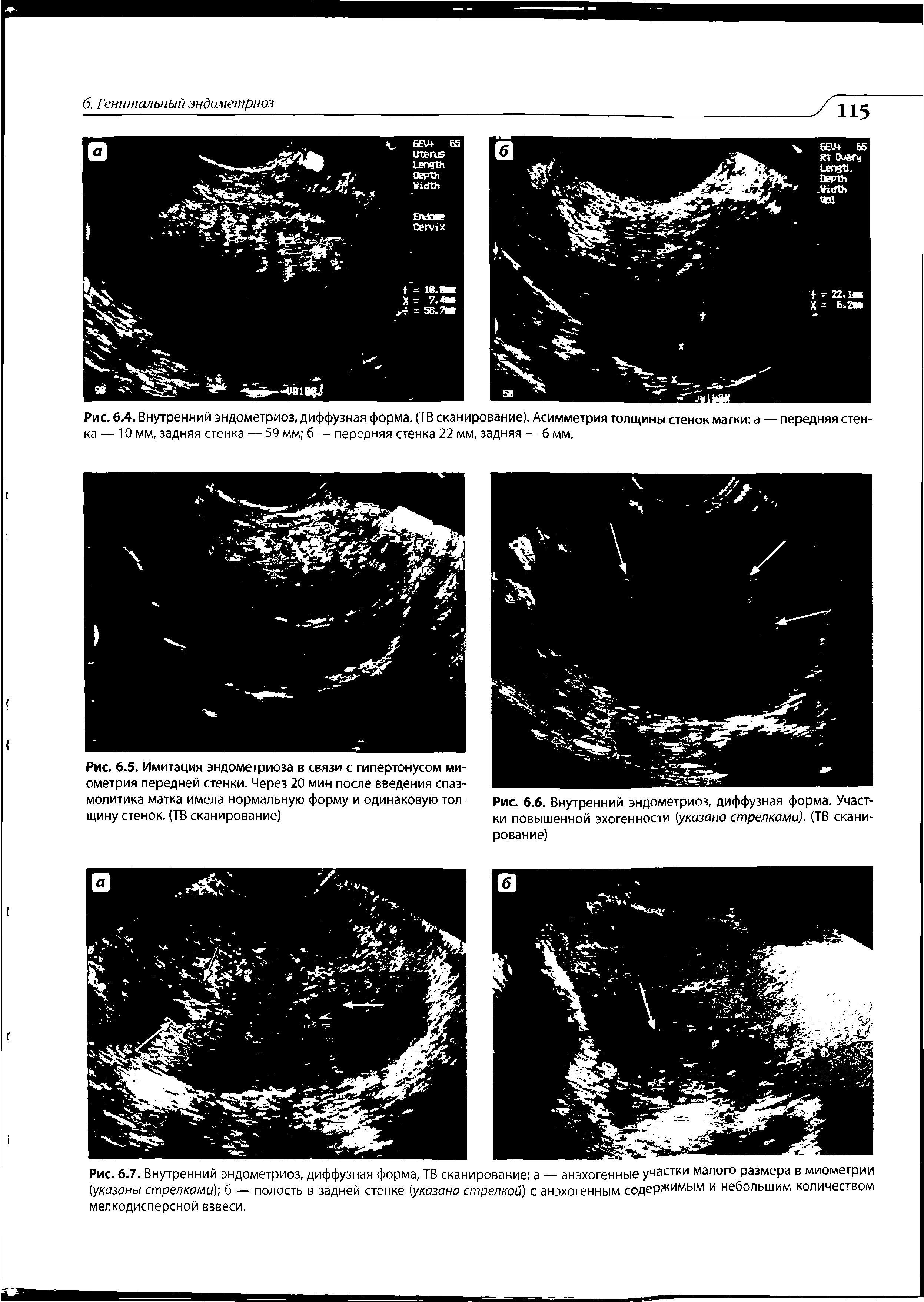 Рис. 6.4. Внутренний эндометриоз, диффузная форма. (ТВ сканирование). Асимметрия толщины стенок магки а — передняя стенка — 10 мм, задняя стенка — 59 мм б — передняя стенка 22 мм, задняя — б мм.