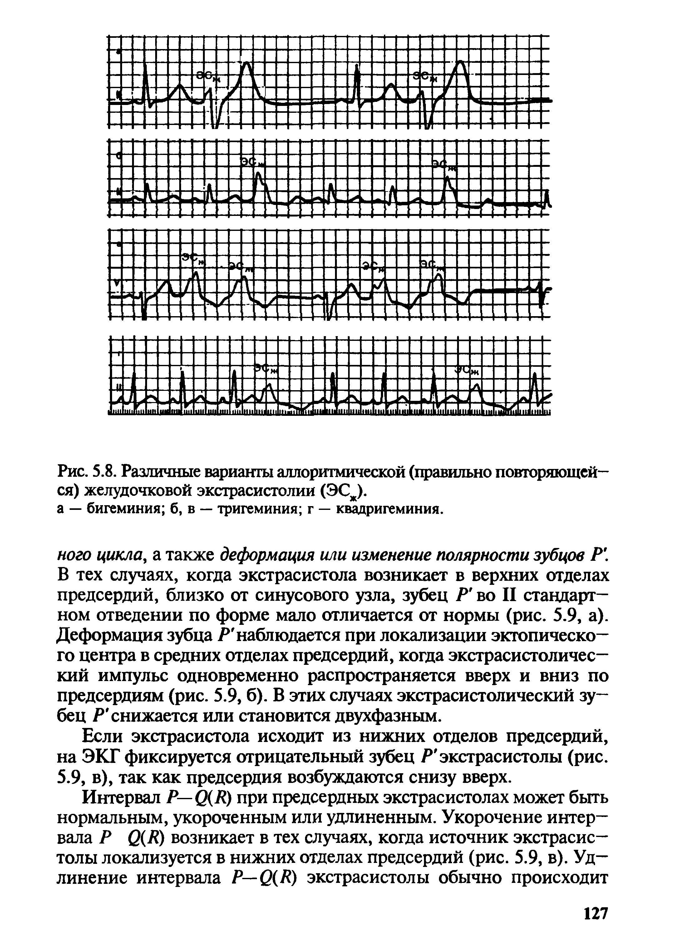 Рис. 5.8. Различные варианты аллоритмической (правильно повторяющейся) желудочковой экстрасистолии (ЭСЖ).