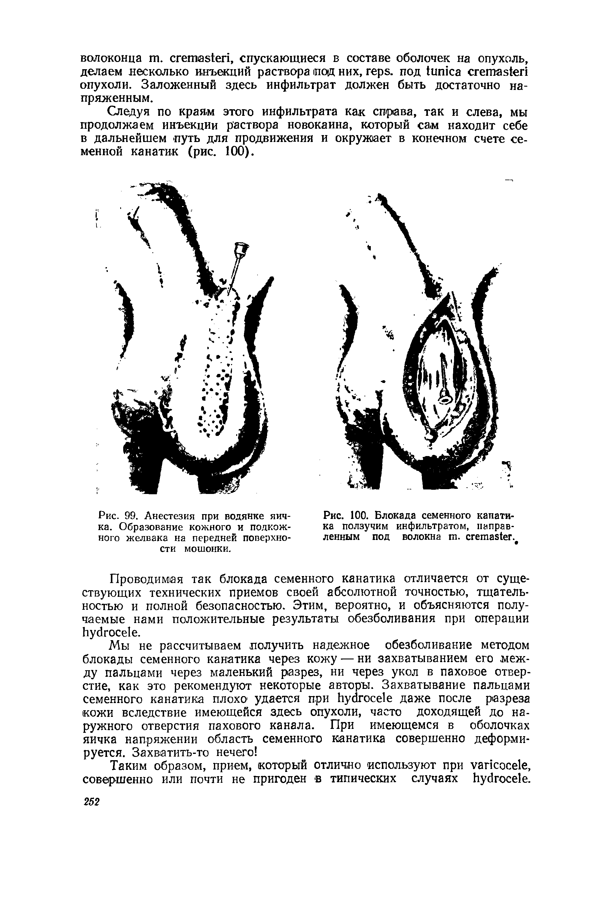 Рис. 99. Анестезия при водянке яичка. Образование кожного и подкожного желвака на передней поверхности мошонки.