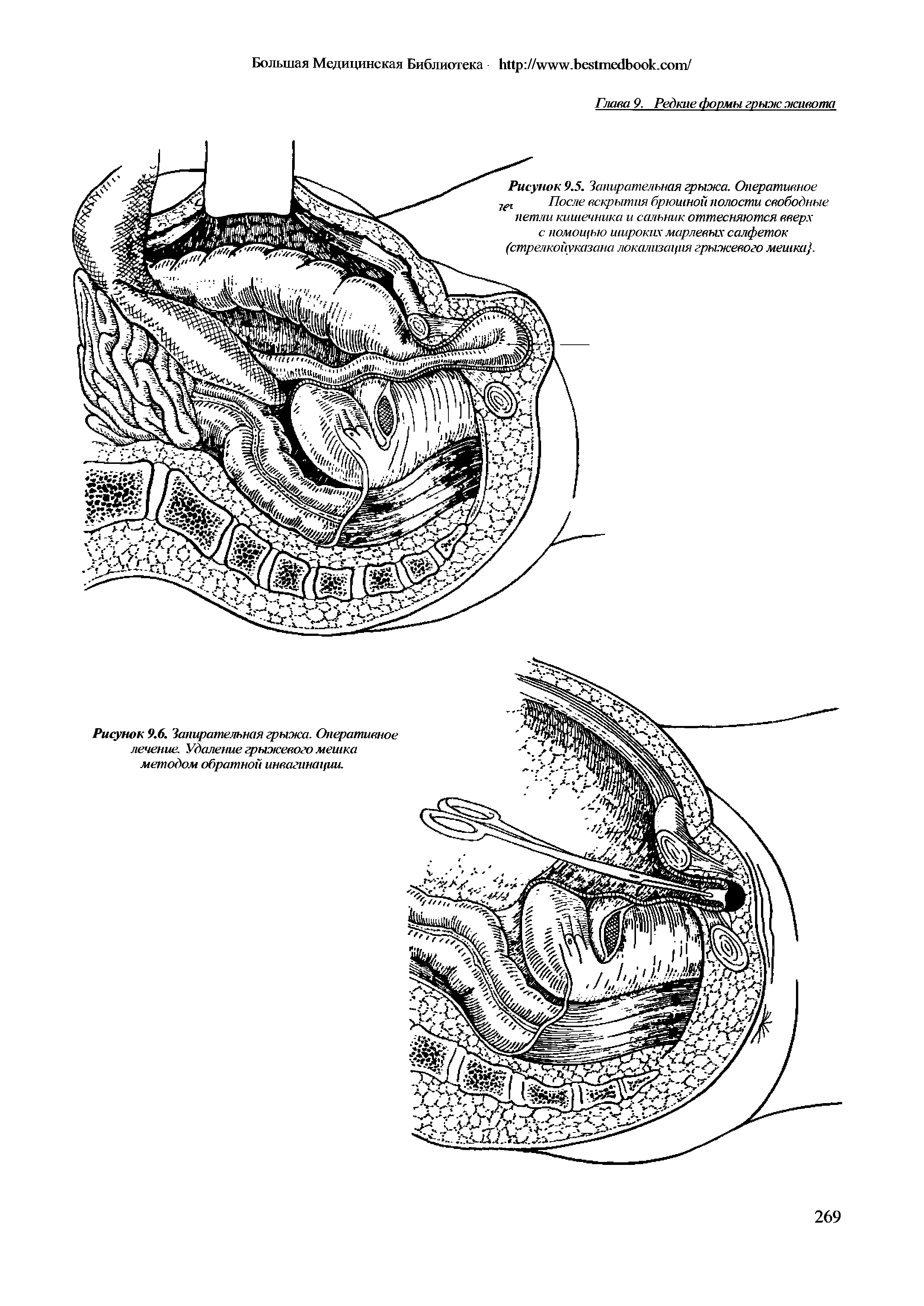 Рисунок 9.5. Запирательная грыжа. Оперативное После вскрытия брюшной полости свободные петли кишечника и сальник оттесняются вверх с помощью широких марлевых салфеток (стрелкойуказана локализация грыжевого мешки. ...