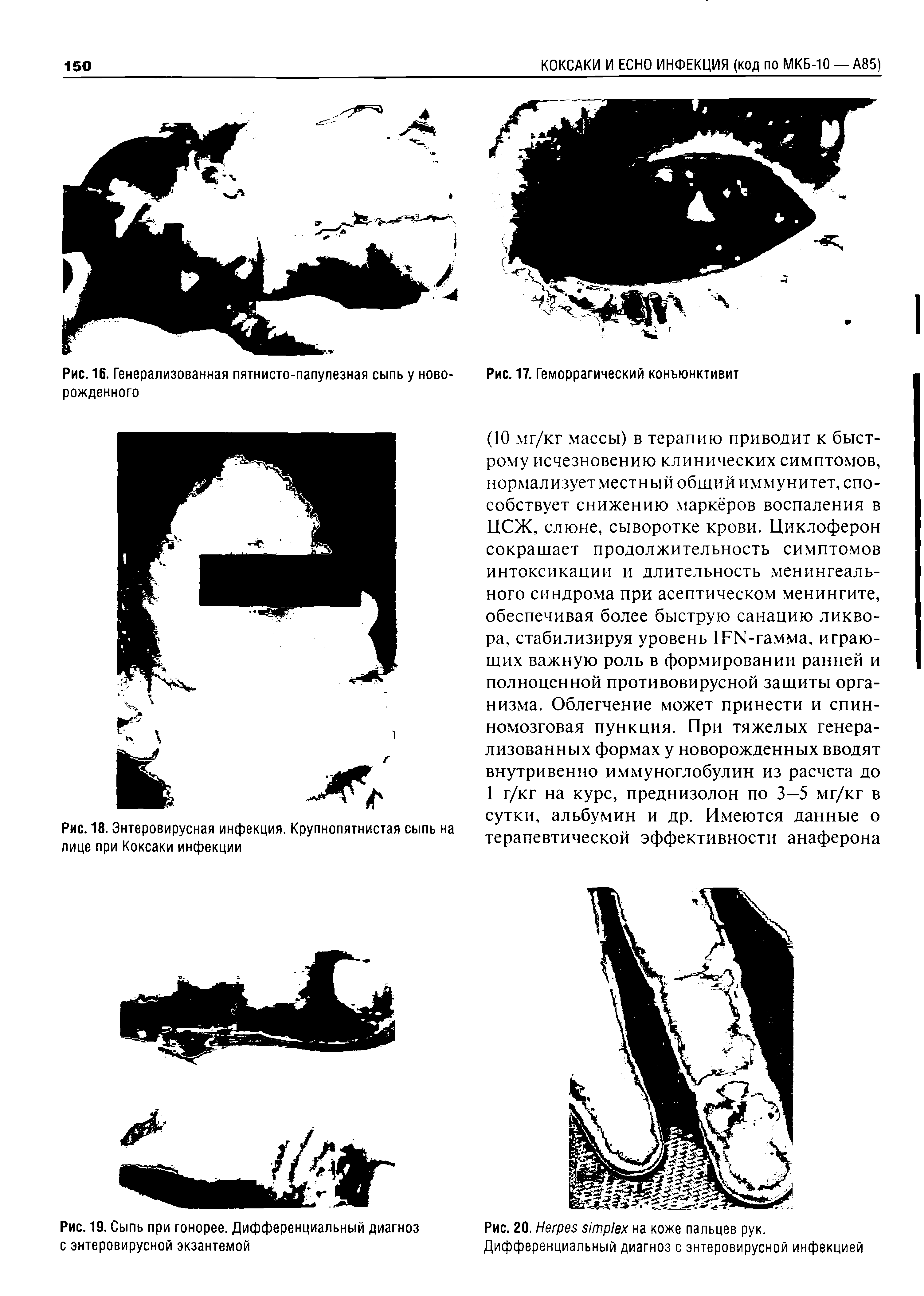 Рис. 18. Энтеровирусная инфекция. Крупнопятнистая сыпь на лице при Коксаки инфекции...