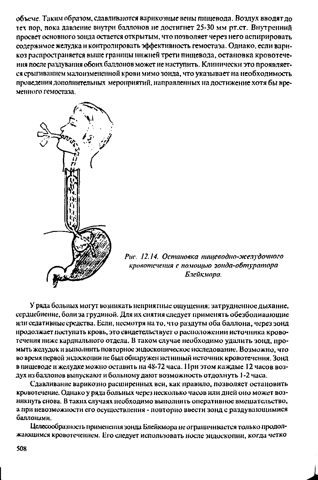 Рис. 12.14. Остановка пищеводно-желудочного кровотечения с помощью зонда-обтуратора Блейкмора.