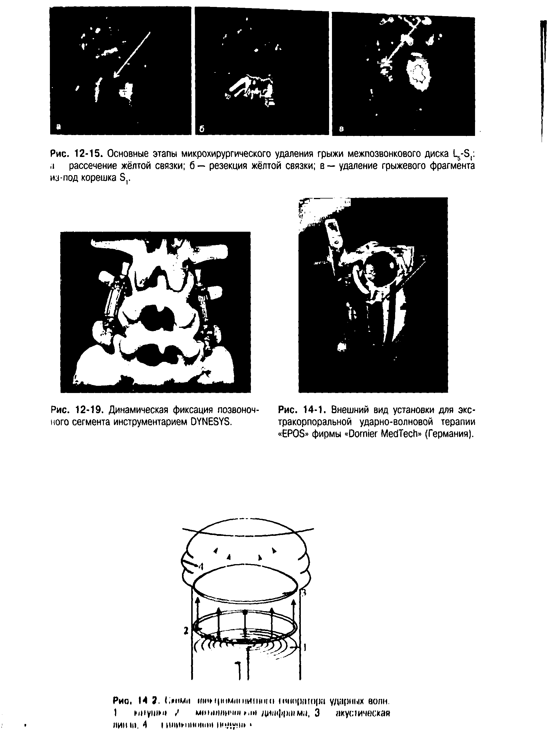 Рис. 12-19. Динамическая фиксация позвоночного сегмента инструментарием DYNESYS.