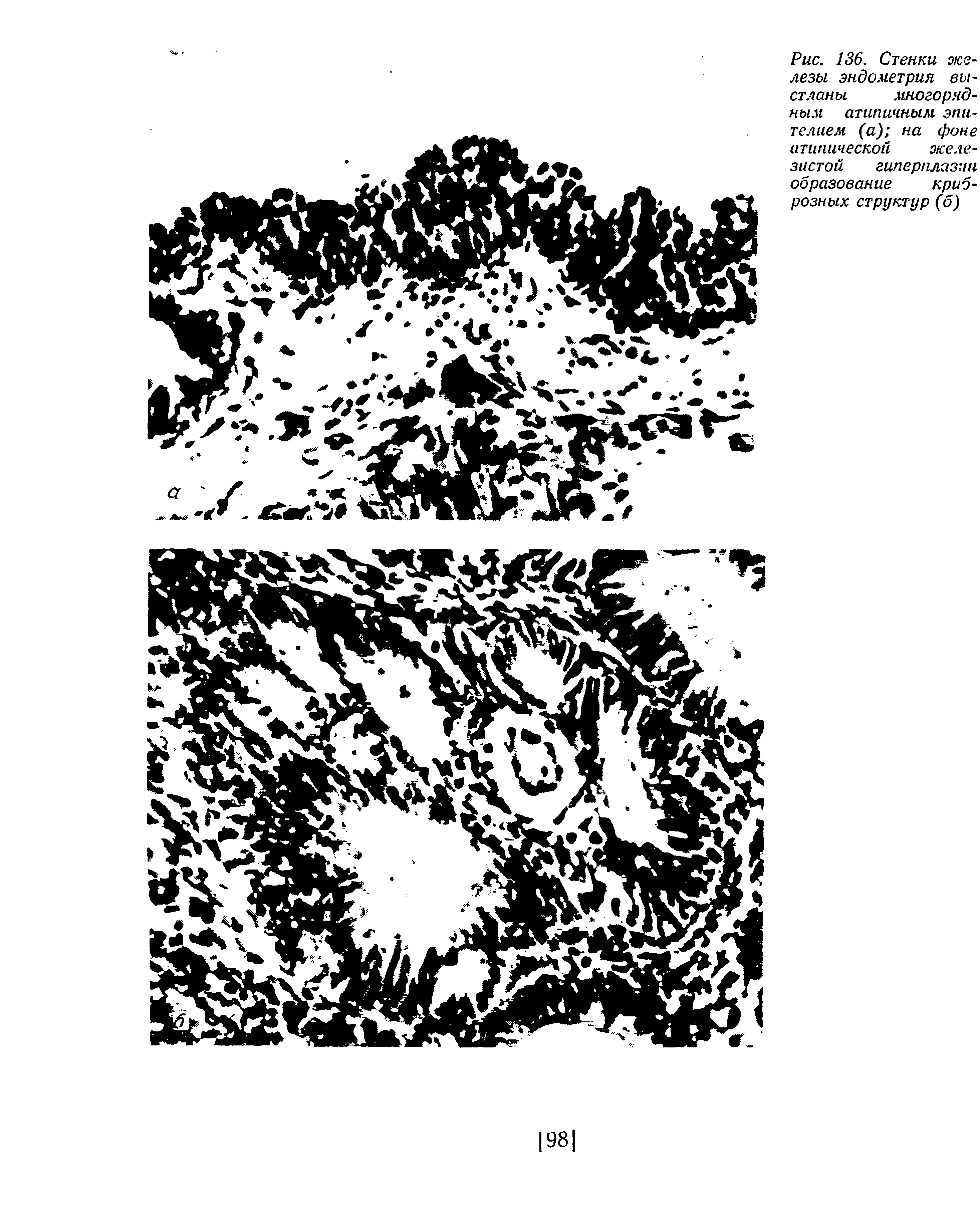 Рис. 136. Стенки железы эндометрия выстланы многорядным атипичным эпителием (а) на фоне атипической желе-...