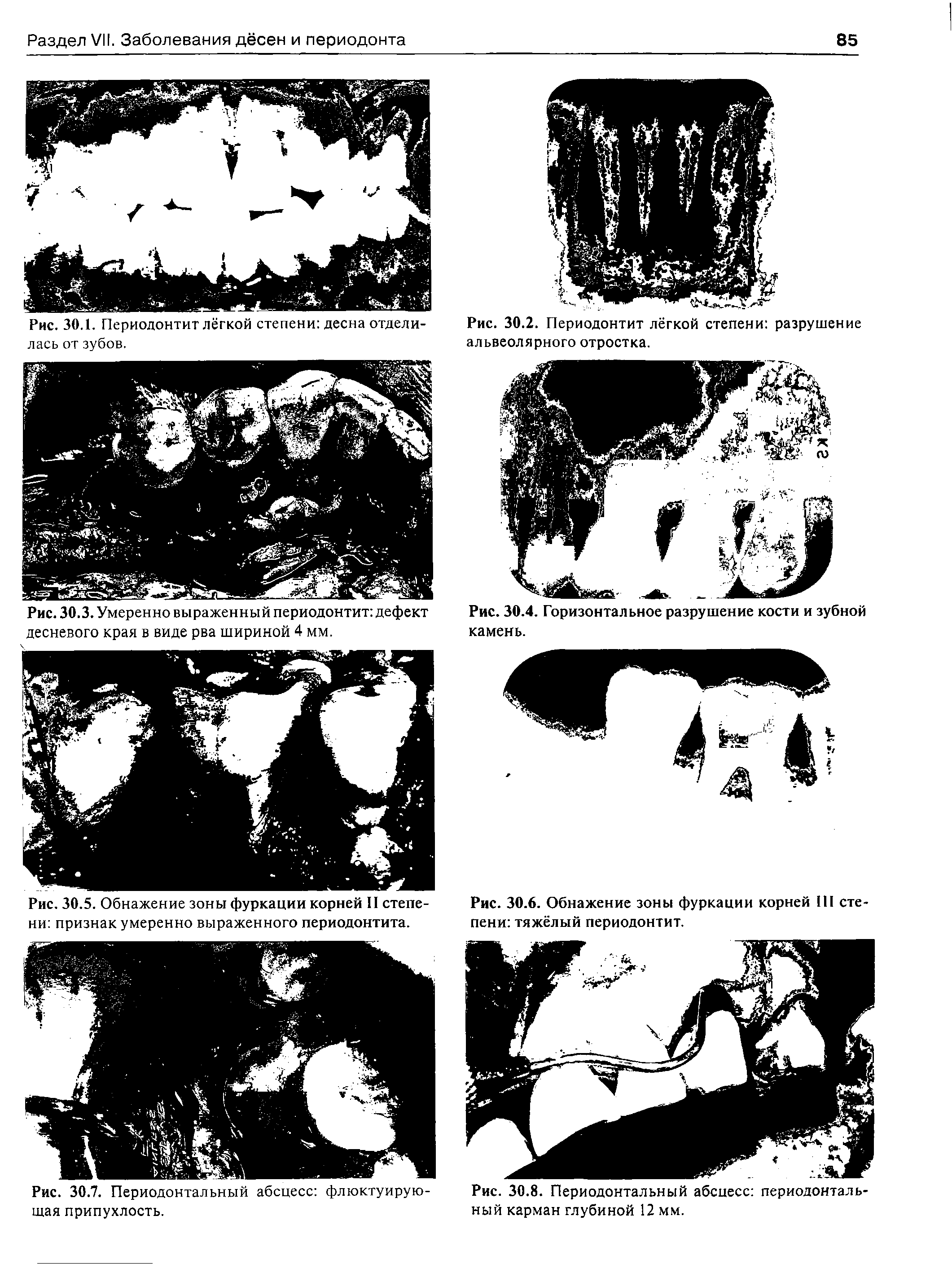 Рис. 30.6. Обнажение зоны фуркации корней III сте пени тяжёлый периодонтит.