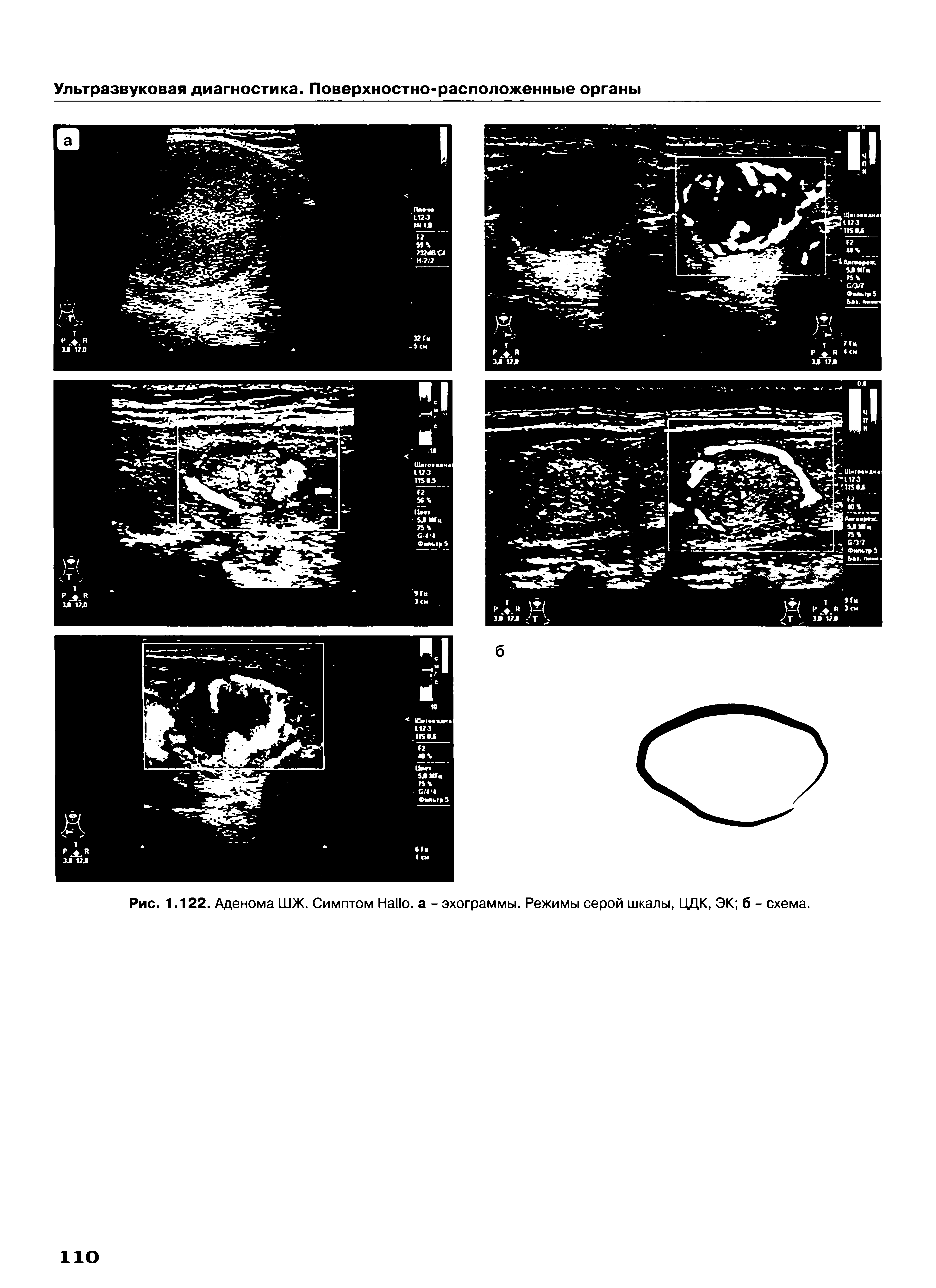 Рис. 1.122. Аденома ШЖ. Симптом H , а - эхограммы. Режимы серой шкалы, ЦДК, ЭК б - схема.