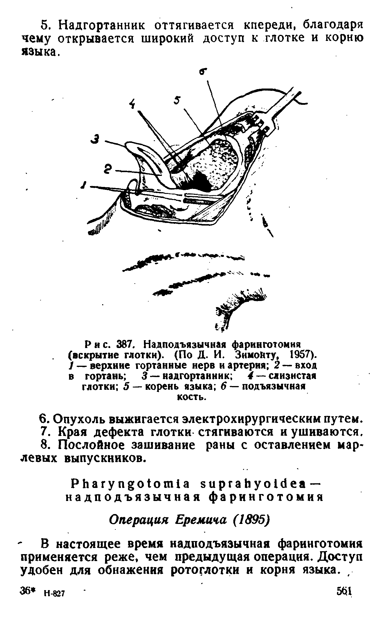 Рис. 387. Надподъязычная фаринготомия (вскрытие глотки). (По Д. И. ЗимоНту, 1957). ) — верхние гортанные нерв и артерия 2 — вход в гортань 3 — надгортанник 4 — слизистая глотки 5 — корень языка 6 — подъязычная кость.