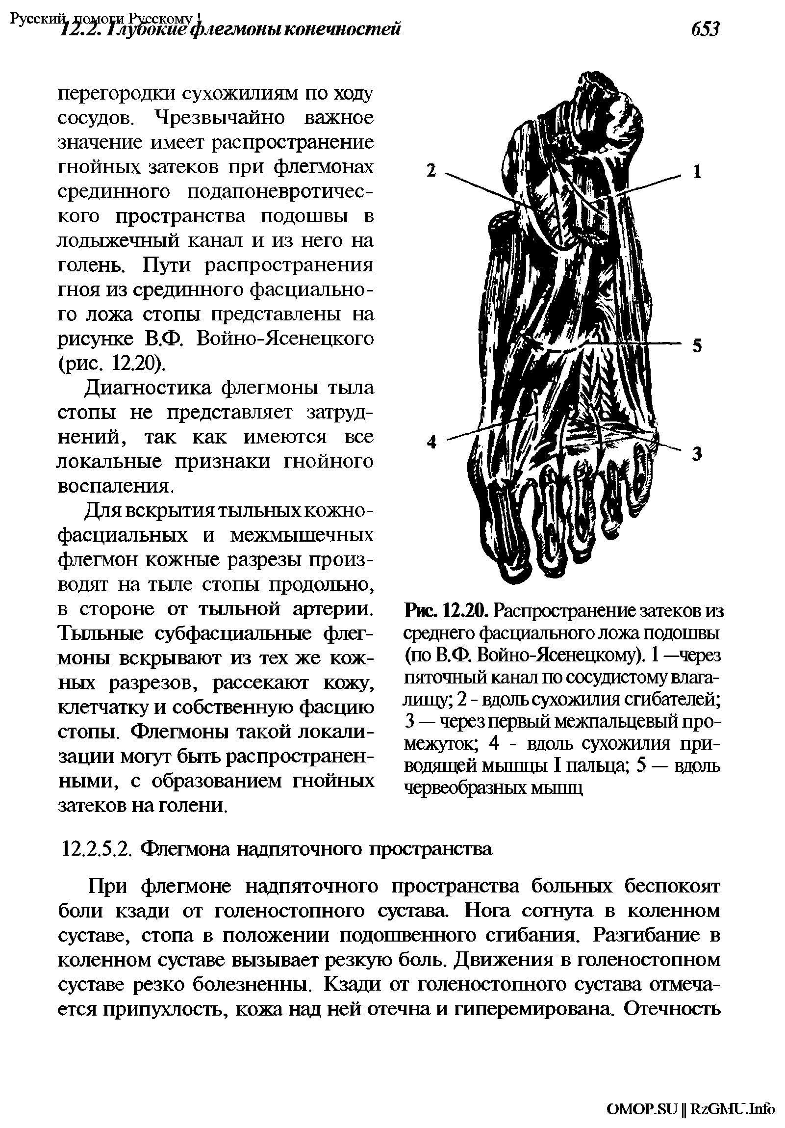 Рис. 12.20. Распространение затеков из среднего фасциального ложа подошвы (по В.Ф. Войно-Ясенецкому). 1 —через пяточный канал по сосудистому влагалищу 2 - вдоль сухожилия сгибателей 3 — через первый межпальцевый промежуток 4 - вдоль сухожилия приводящей мышцы I пальца 5 — вдоль червеобразных мышц...