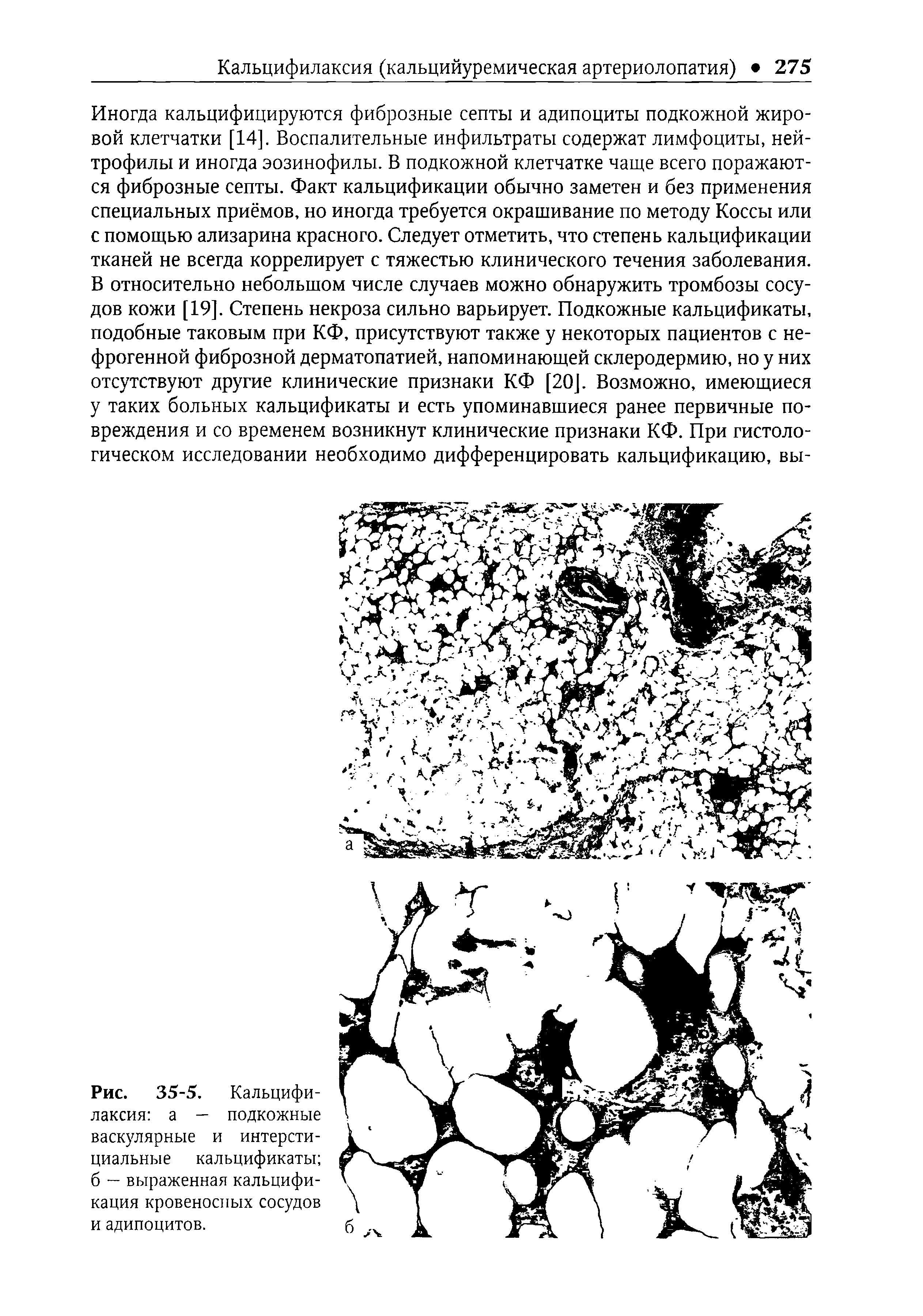 Рис. 35-5. Кальцифилаксия а — подкожные васкулярные и интерстициальные кальцификаты б — выраженная кальцификация кровеносных сосудов и адипоцитов.