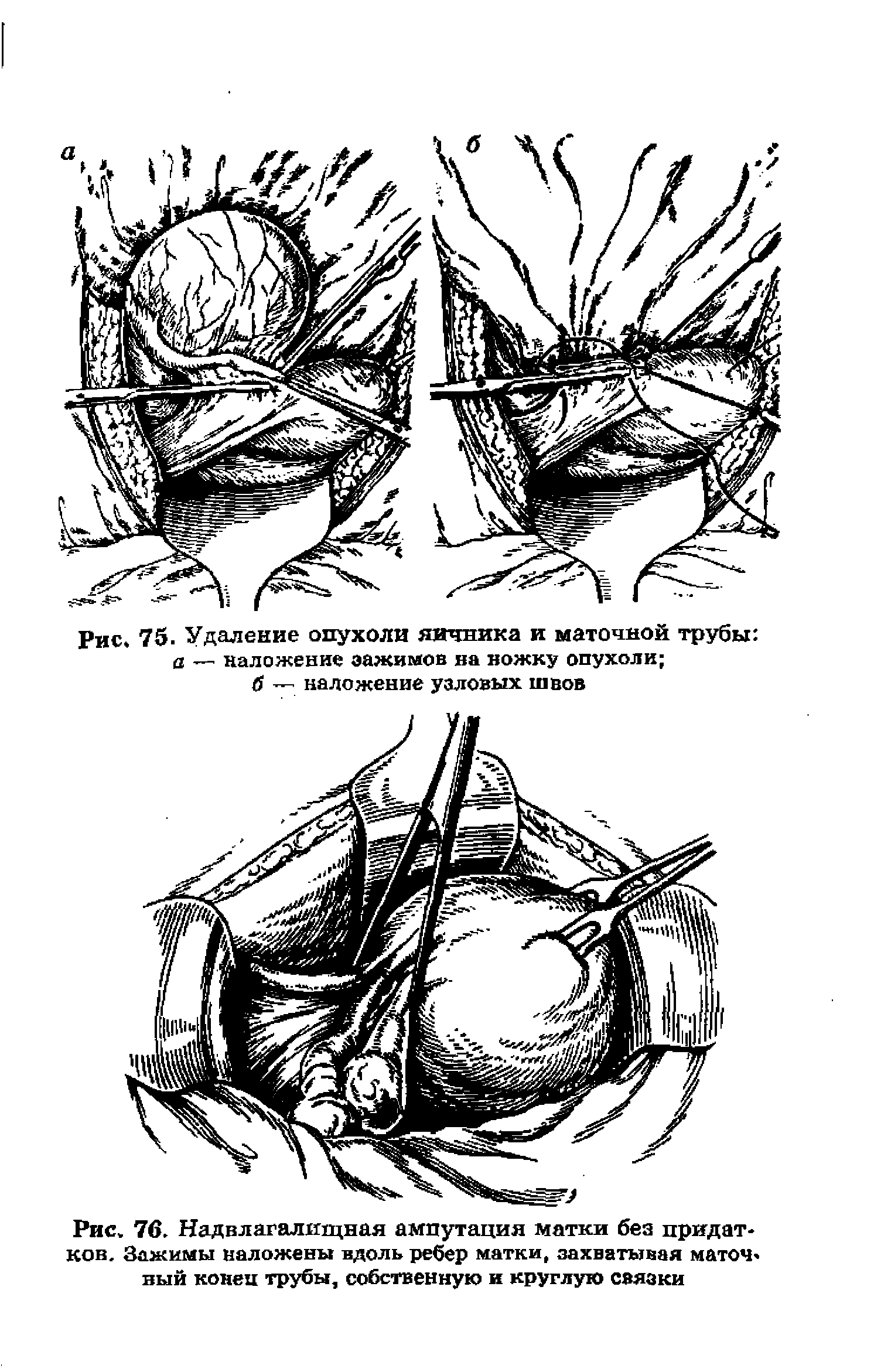 Рис. 76. Надвлагалищная ампутация матки без придатков. Зажимы наложены вдоль ребер матки, захватывая маточный конец трубы, собственную и круглую связки...