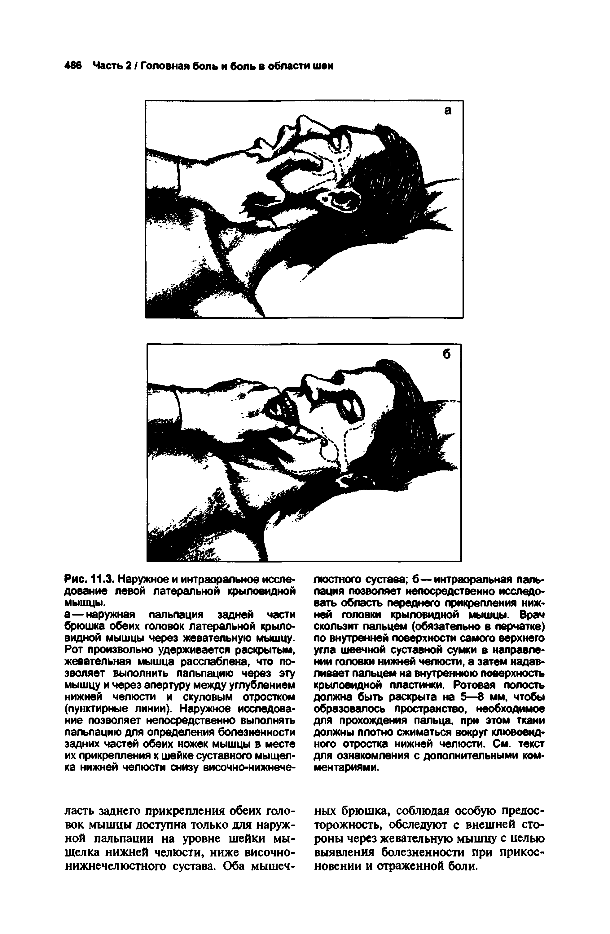 Рис. 11.3. Наружное и интраоральное исследование левой латеральной крыловидной мышцы.