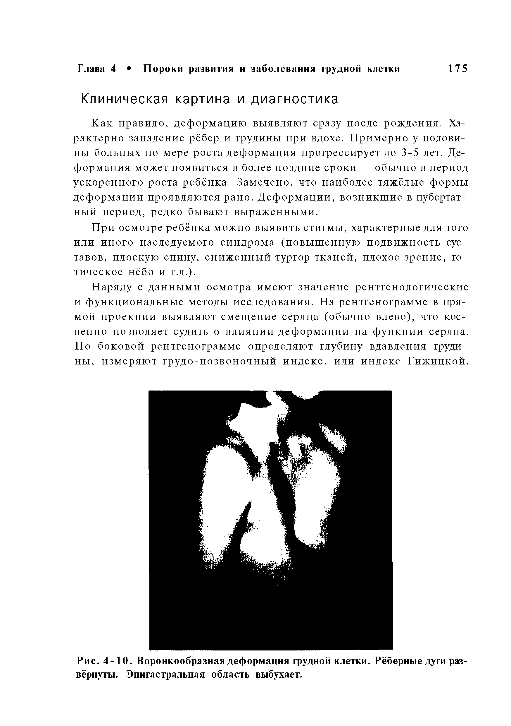 Рис. 4-10. Воронкообразная деформация грудной клетки. Рёберные дуги развёрнуты. Эпигастральная область выбухает.