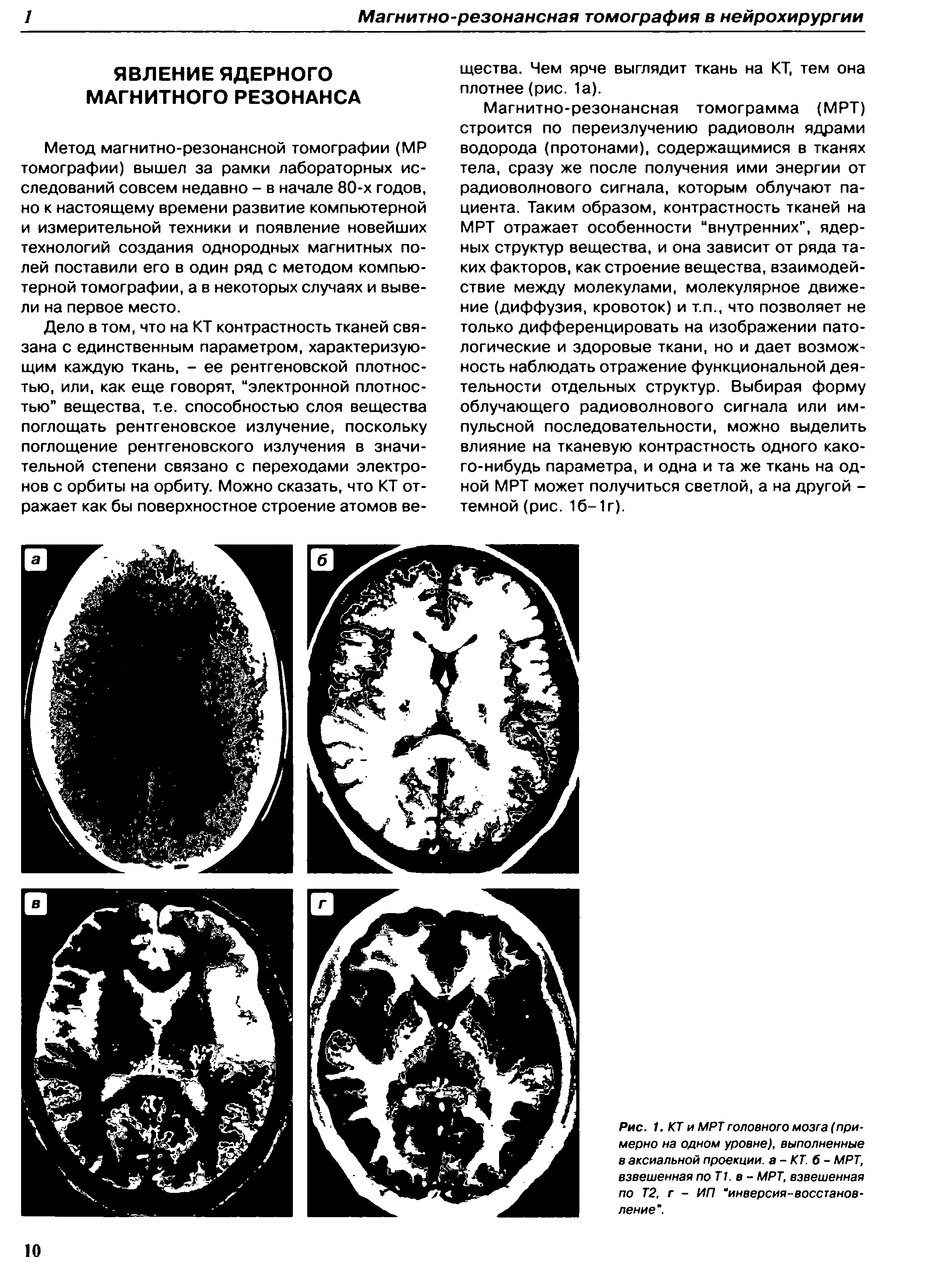 Рис. 1. КТ и МРТ головного мозга (примерно на одном уровне), выполненные в аксиальной проекции, а-КТ. б- МРТ, взвешенная поТ1. в - МРТ, взвешенная по Т2, г - ИП инверсия-восстановление".