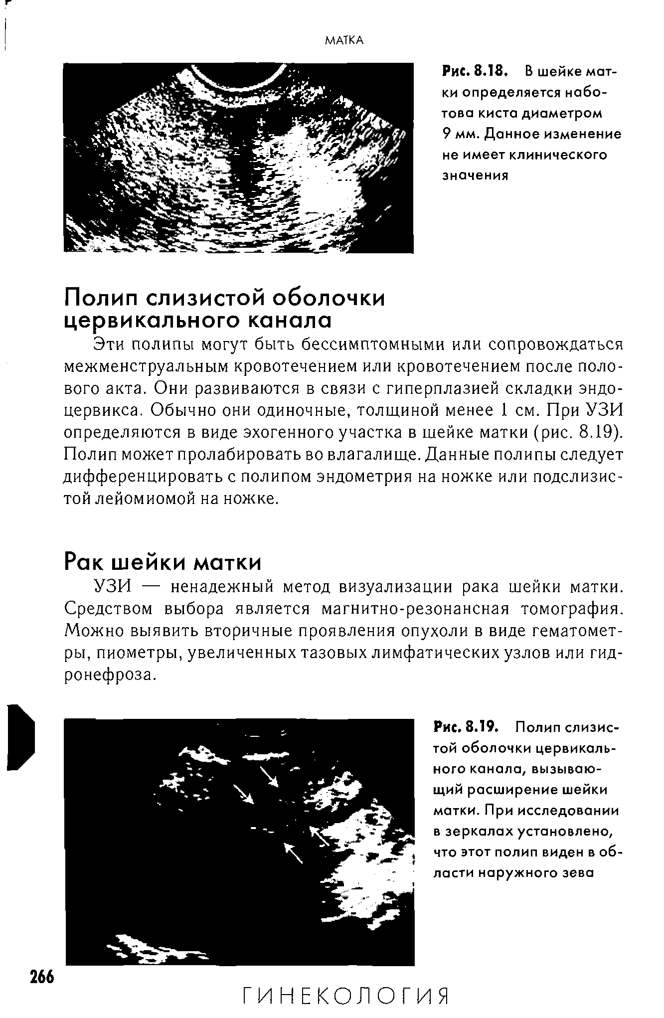 Рис. 8.19. Полип слизистой оболочки цервикального канала, вызывающий расширение шейки матки. При исследовании в зеркалах установлено, что этот полип виден в области наружного зева...