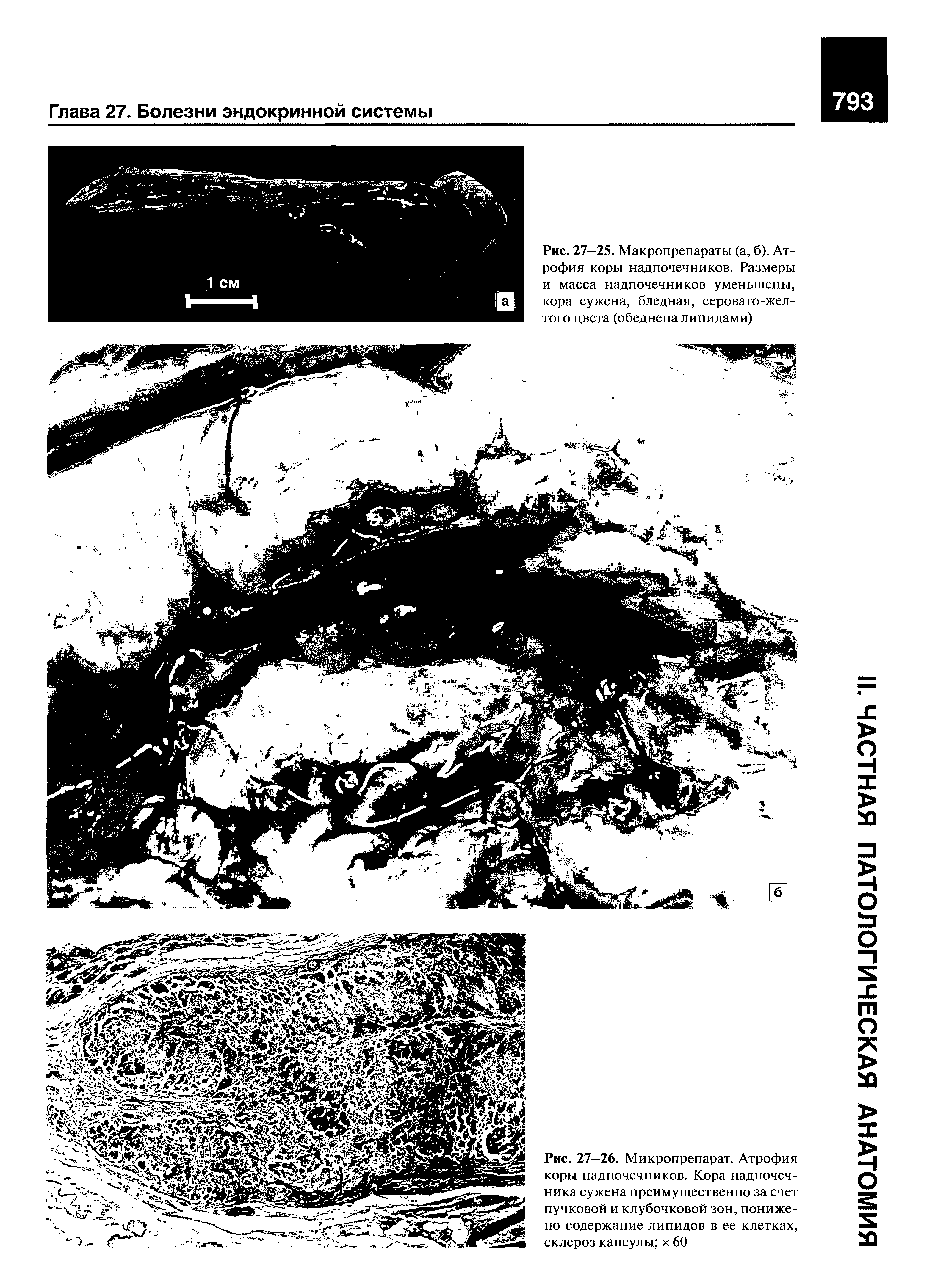 Рис. 27—25. Макропрепараты (а, б). Атрофия коры надпочечников. Размеры и масса надпочечников уменьшены, кора сужена, бледная, серовато-желтого цвета (обеднена липидами)...