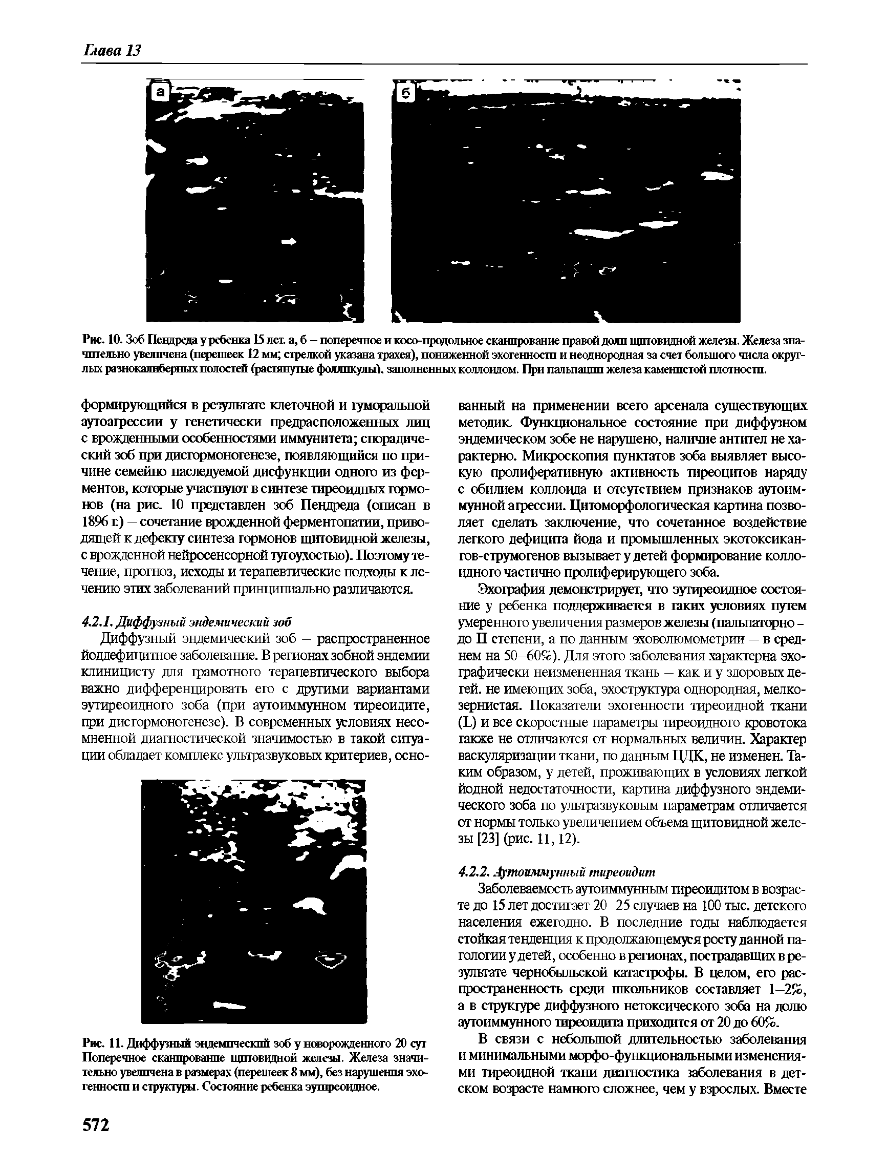 Рис. 11. Диффузный эндемический зоб у новорожденного 20 сут Поперечное сканирование щитовидной железы. Железа значительно увеличена в размерах (перешеек 8 мм), без нарушения эхогенности и структуры. Состояние ребенка эутиреоидное.