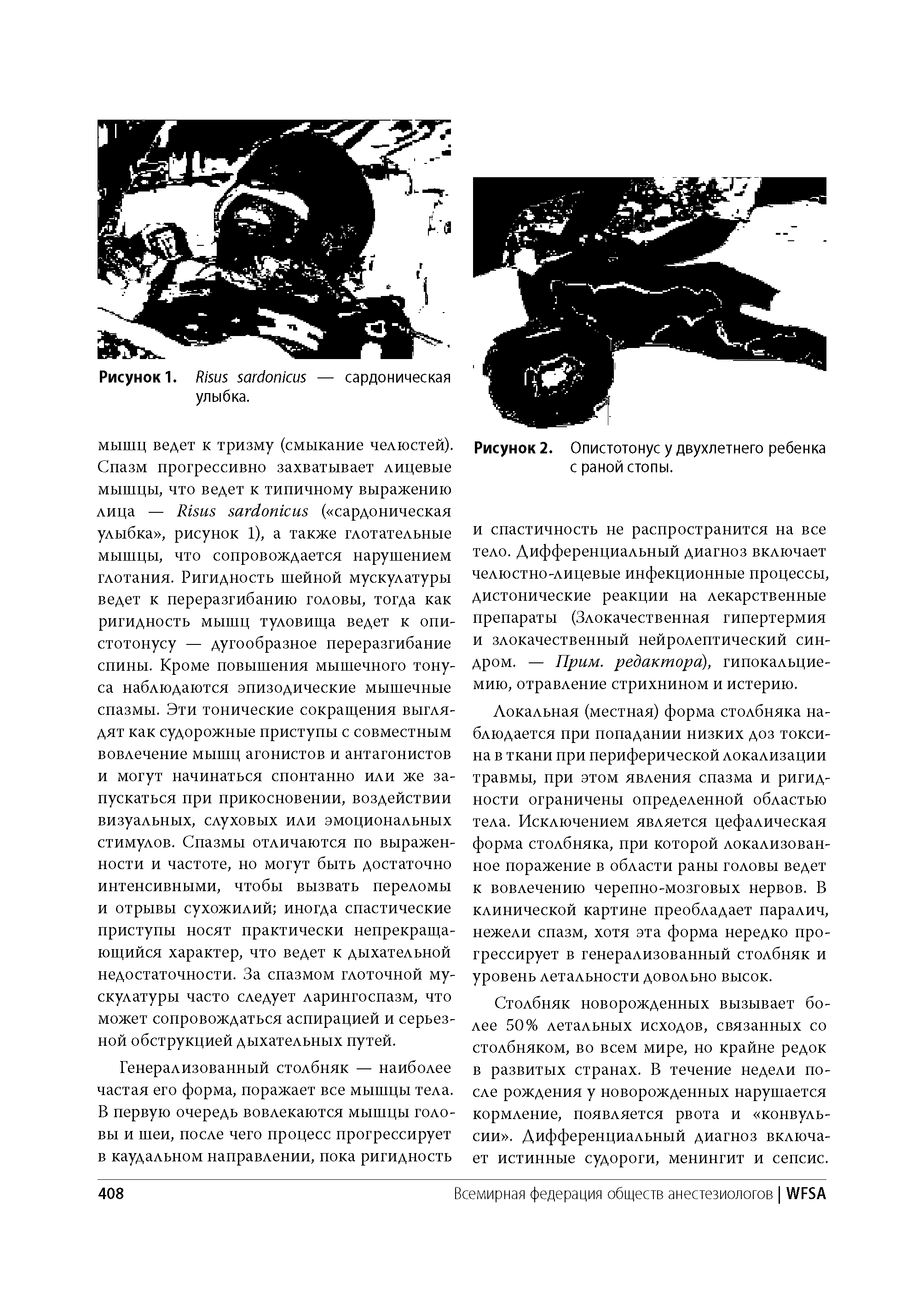 Рисунок 2. Опистотонус у двухлетнего ребенка с раной стопы.