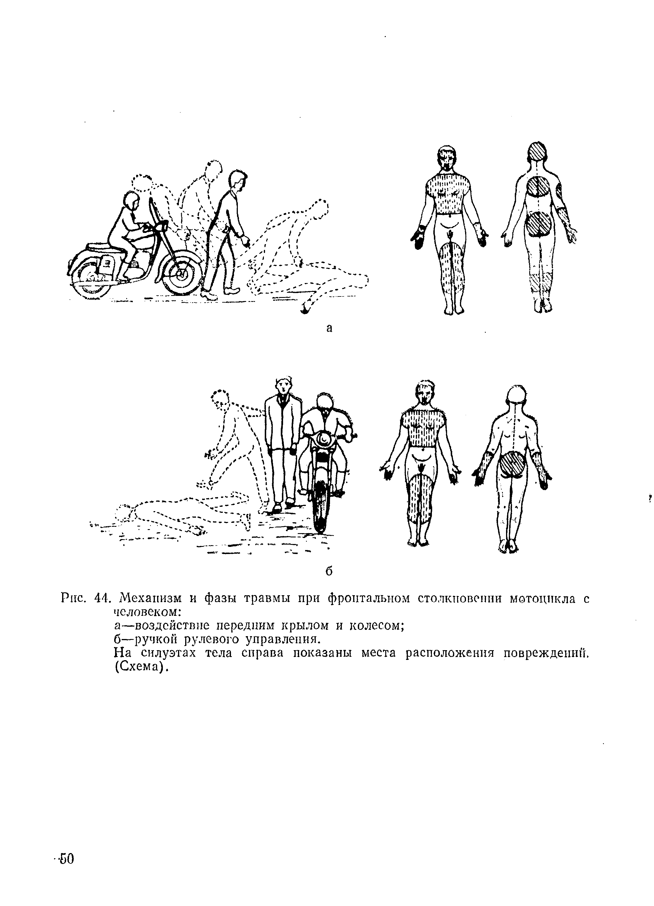 Рис. 44. Механизм и фазы травмы при фронтальном столкновении мотоцикла с человеком ...