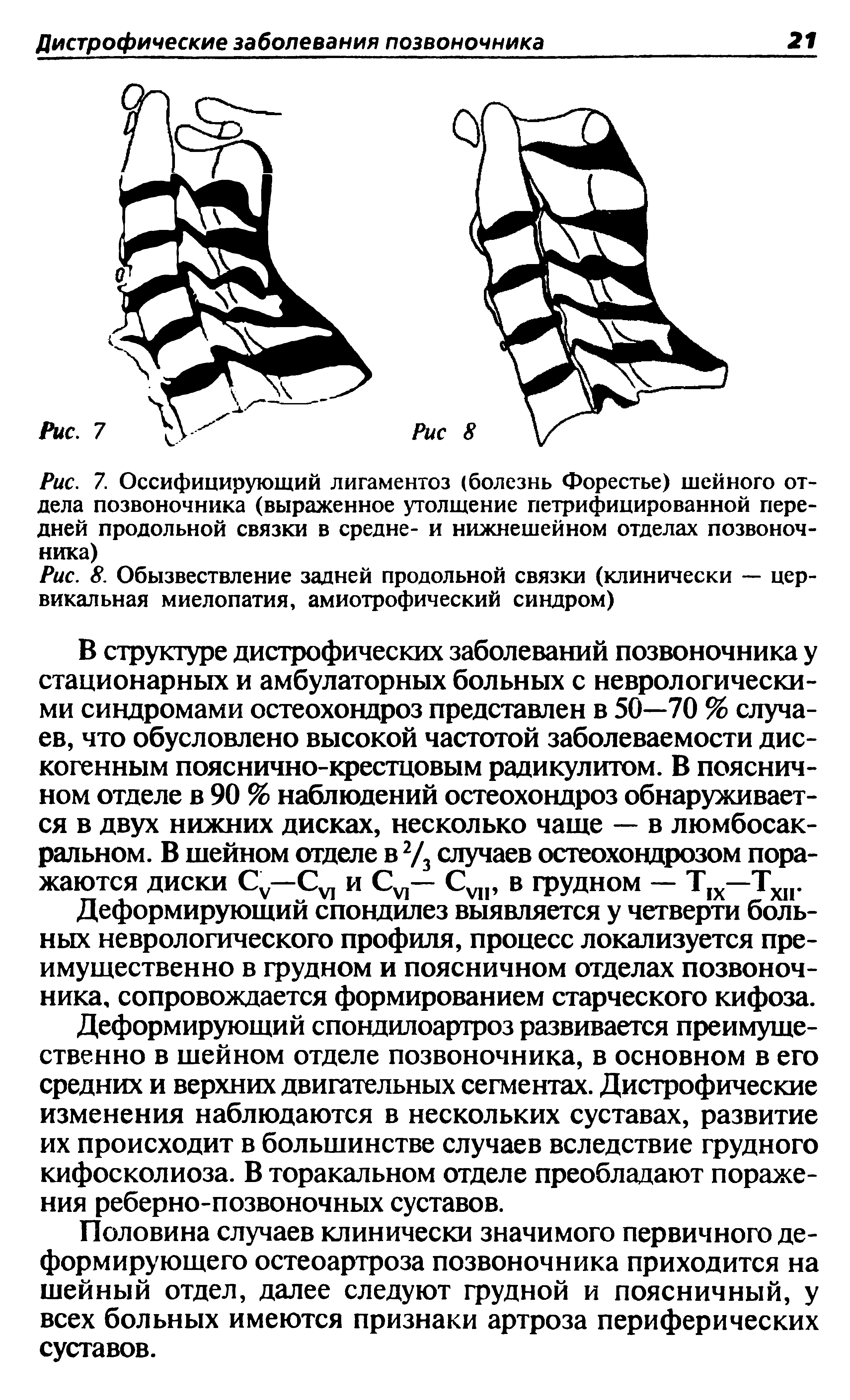 Рис. 7. Оссифицирующий лигаментоз (болезнь Форестье) шейного отдела позвоночника (выраженное утолщение петрифицированной передней продольной связки в средне- и нижнешейном отделах позвоночника)...