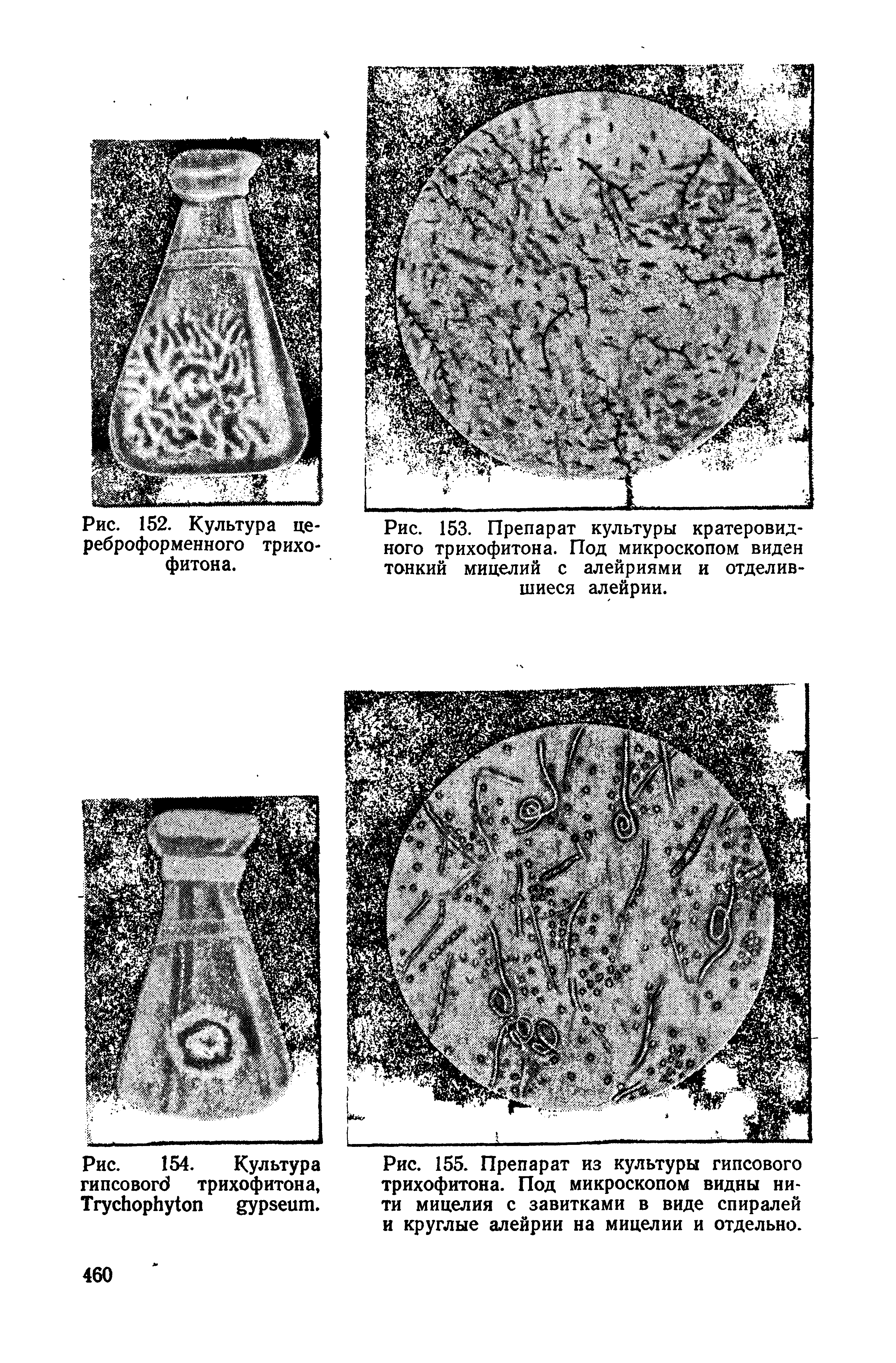Рис. 153. Препарат культуры кратеровидного трихофитона. Под микроскопом виден тонкий мицелий с алейриями и отделив-...
