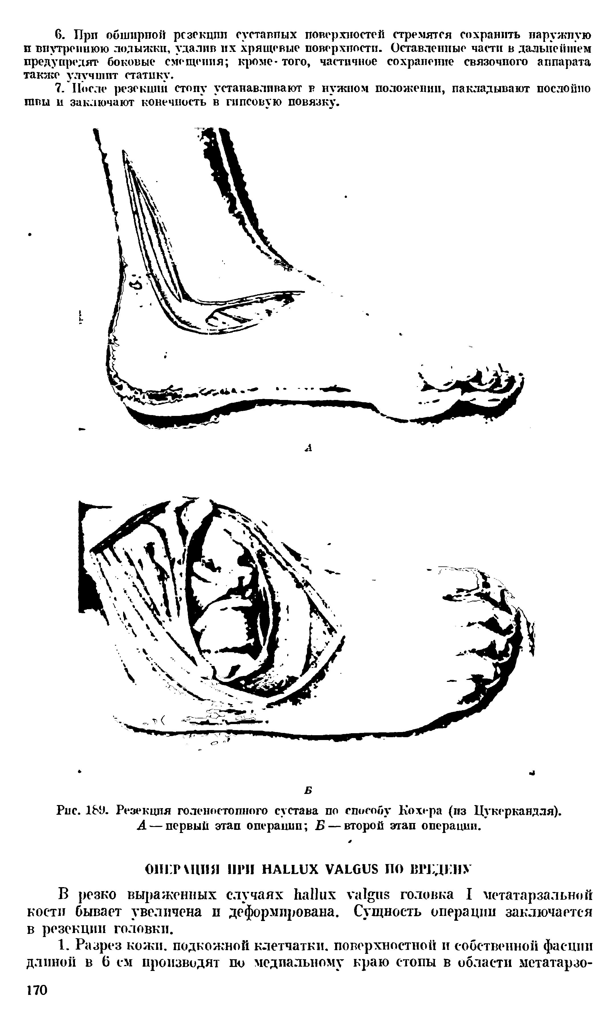 Рис. 189. Резекцпя голеностопного сустава по способу Кохера (из Цукеркандля). А— первый этап операции Б — второй этап операции.