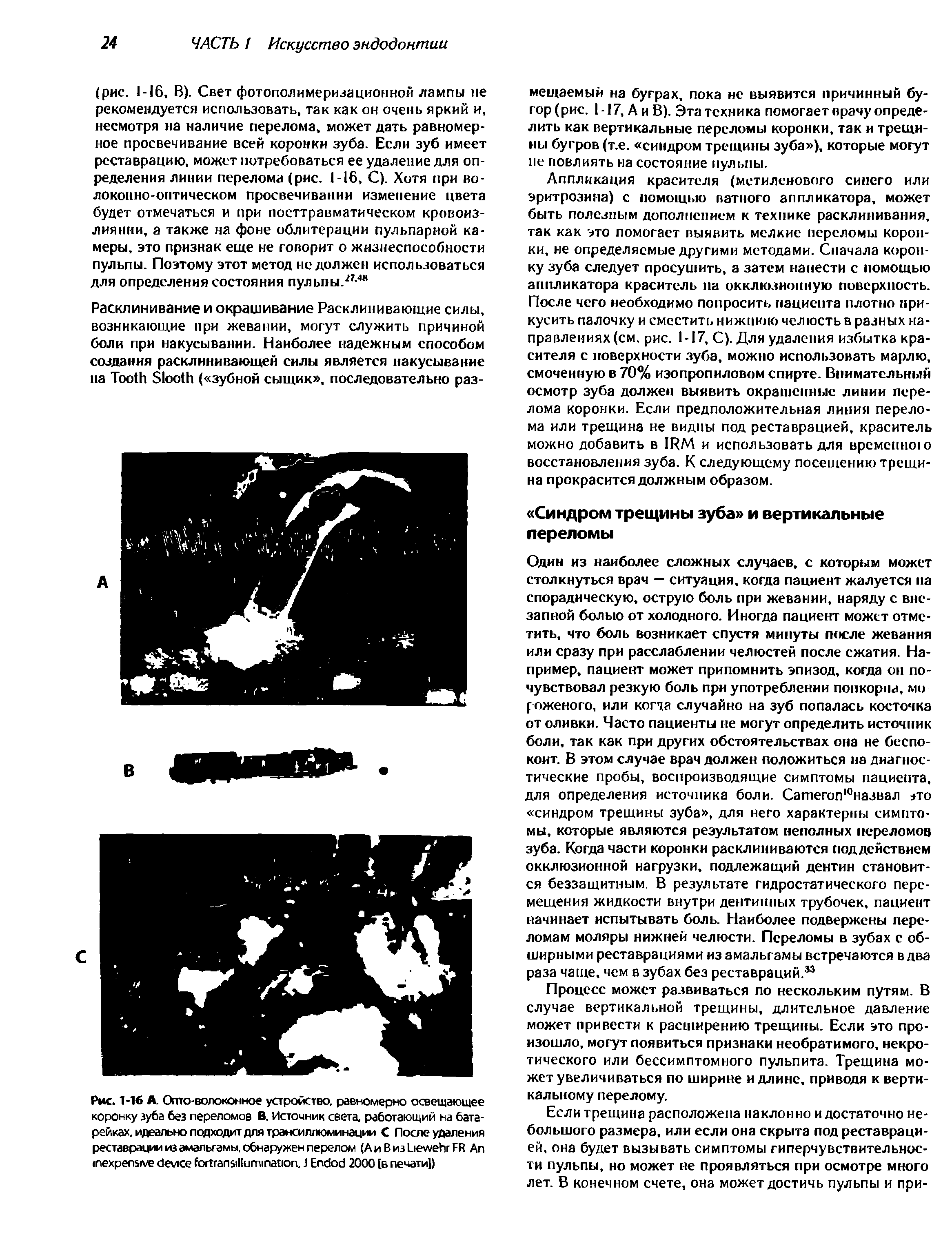 Рис. 1-16 А Опто-волоконное устройство, равномерно освещающее коронку зуба без переломов В. Источник света, работающий на батарейках, идеально подходит для трансиллюминации С После удаления реставрации из амальгамы, обнаружен перелом (A B 3L FR Ап . J E 2000 [в печати])...