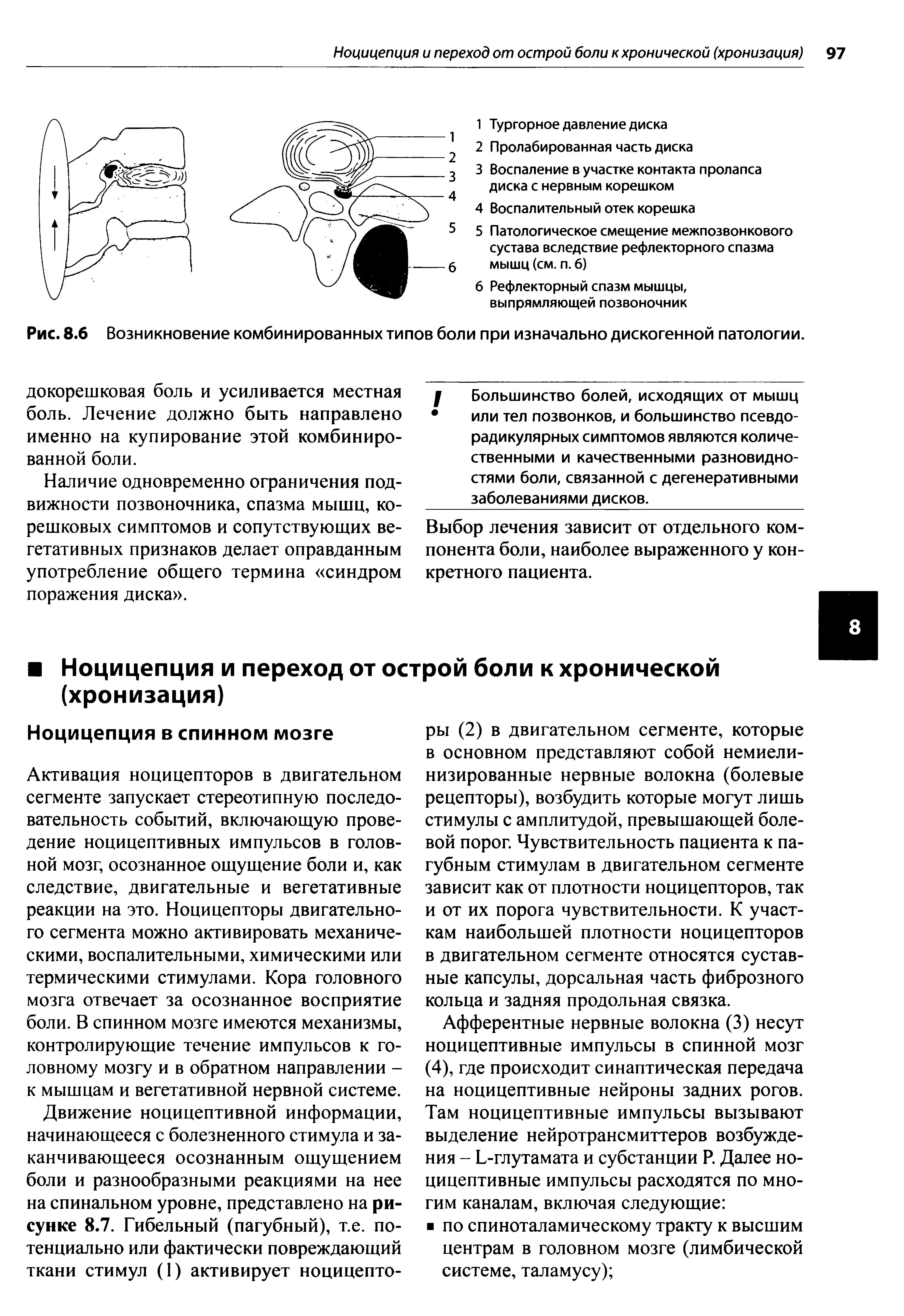 Рис. 8.6 Возникновение комбинированных типов боли при изначально дискогенной патологии.