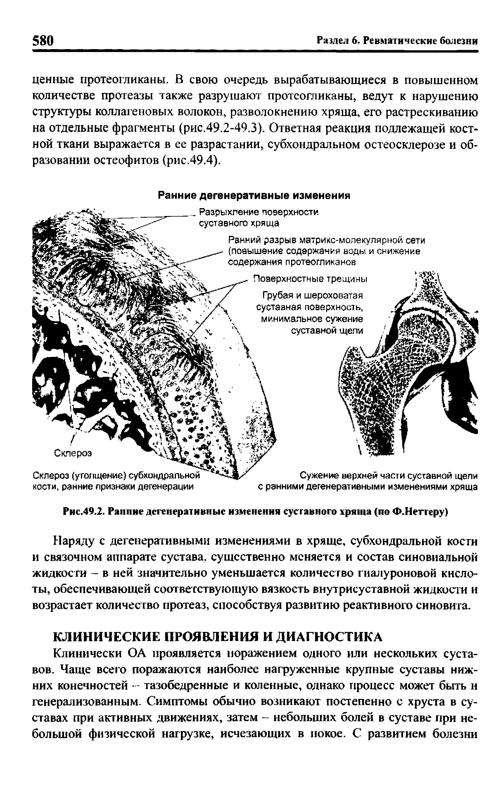 Рис.49.2. Ранние дегенеративные изменения суст авного хряща (по Ф.Нетгеру)...